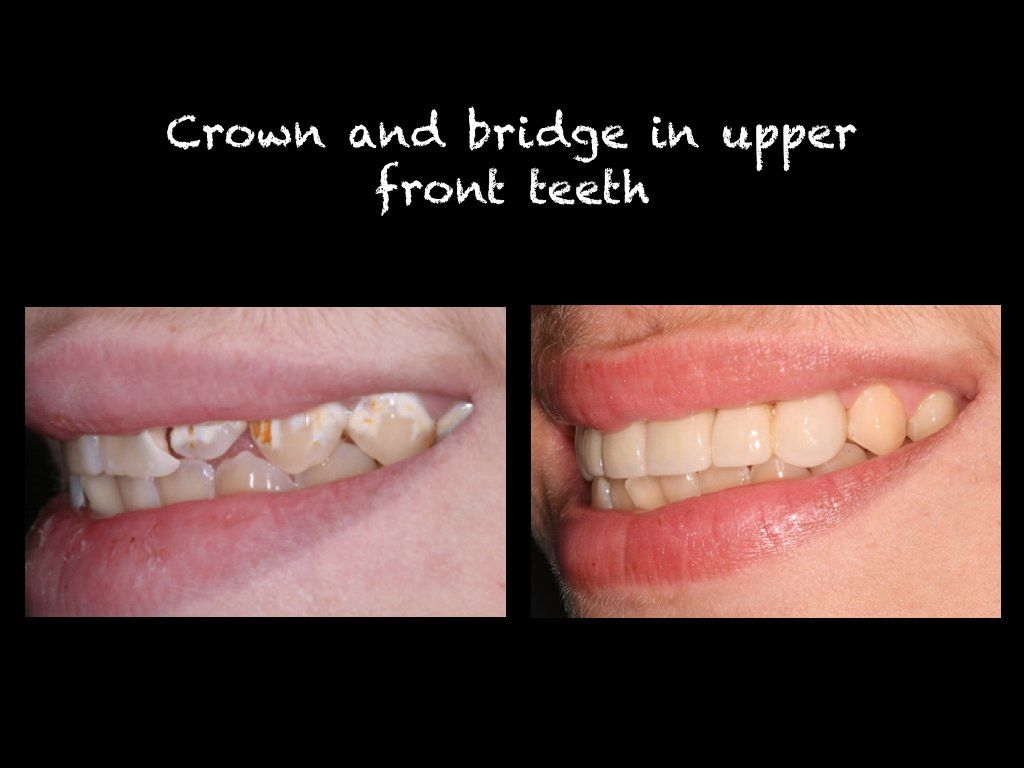 Crown and bridge in upper front teeth
