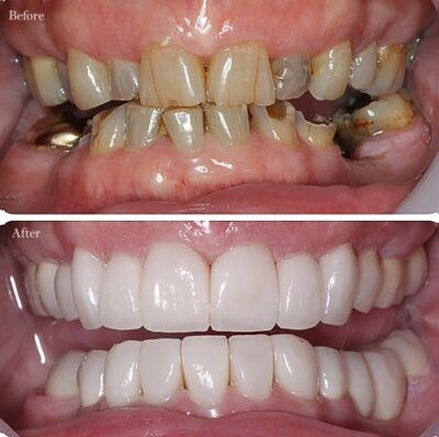 A before and after picture of a person 's teeth