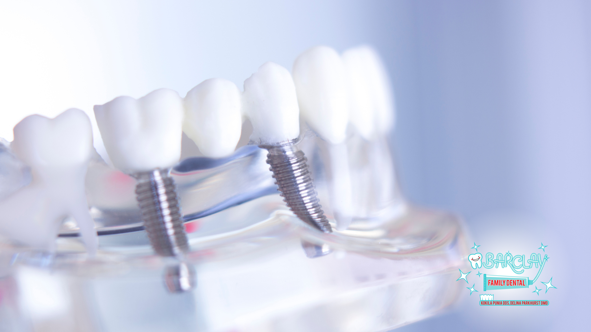 Close-up of dental implants on a model jaw. Shows screws and white tooth crowns.