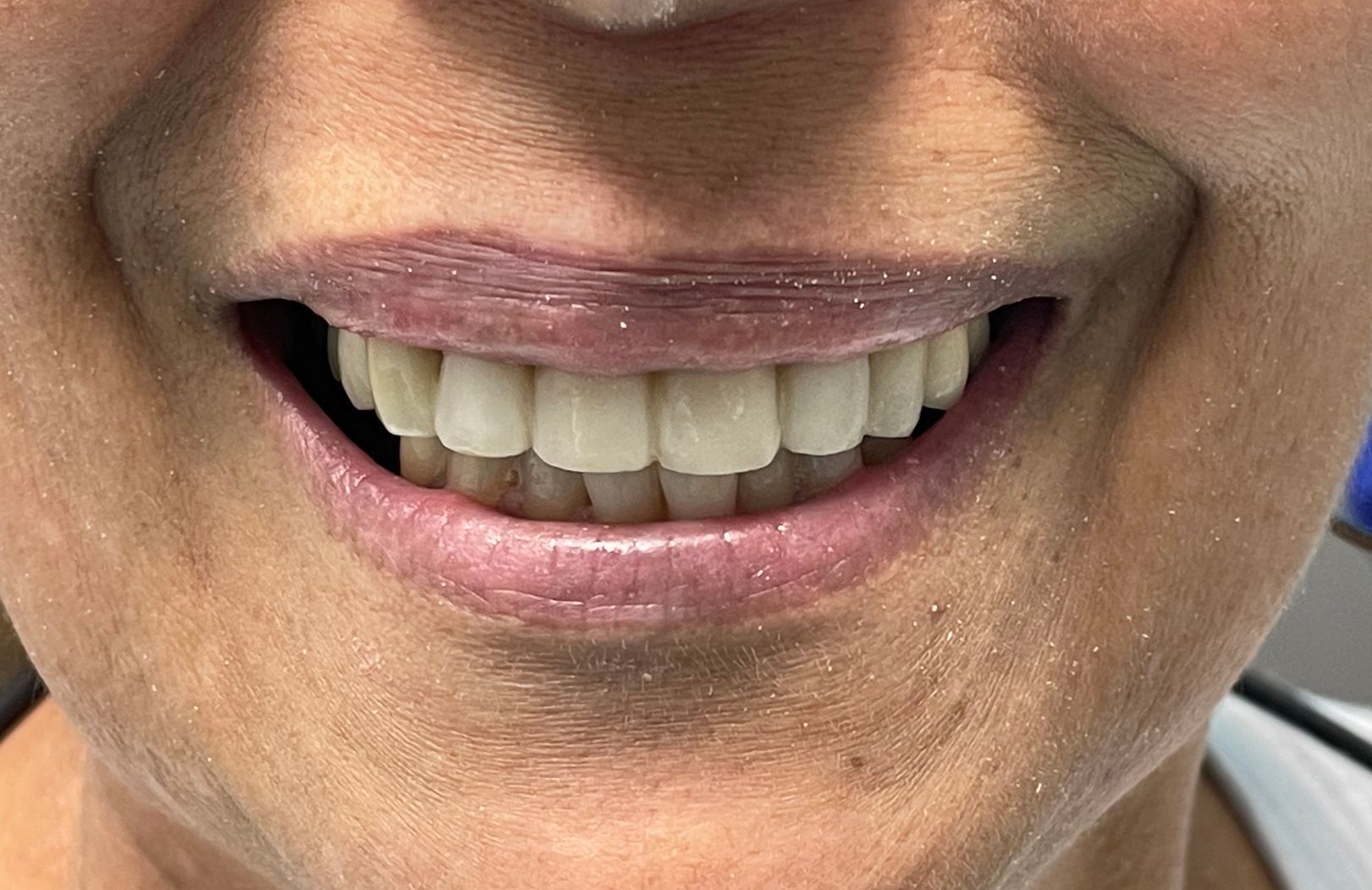 a close up of a woman 's smile with white teeth | Dental Crowns | Restoration and Smile makeover | Before and After Dental Treatment | Barclay Family Dental | Best Dentist For Family Dentistry, Dental Implants, and Cosmetic Dentistry in Cherry Hill, NJ