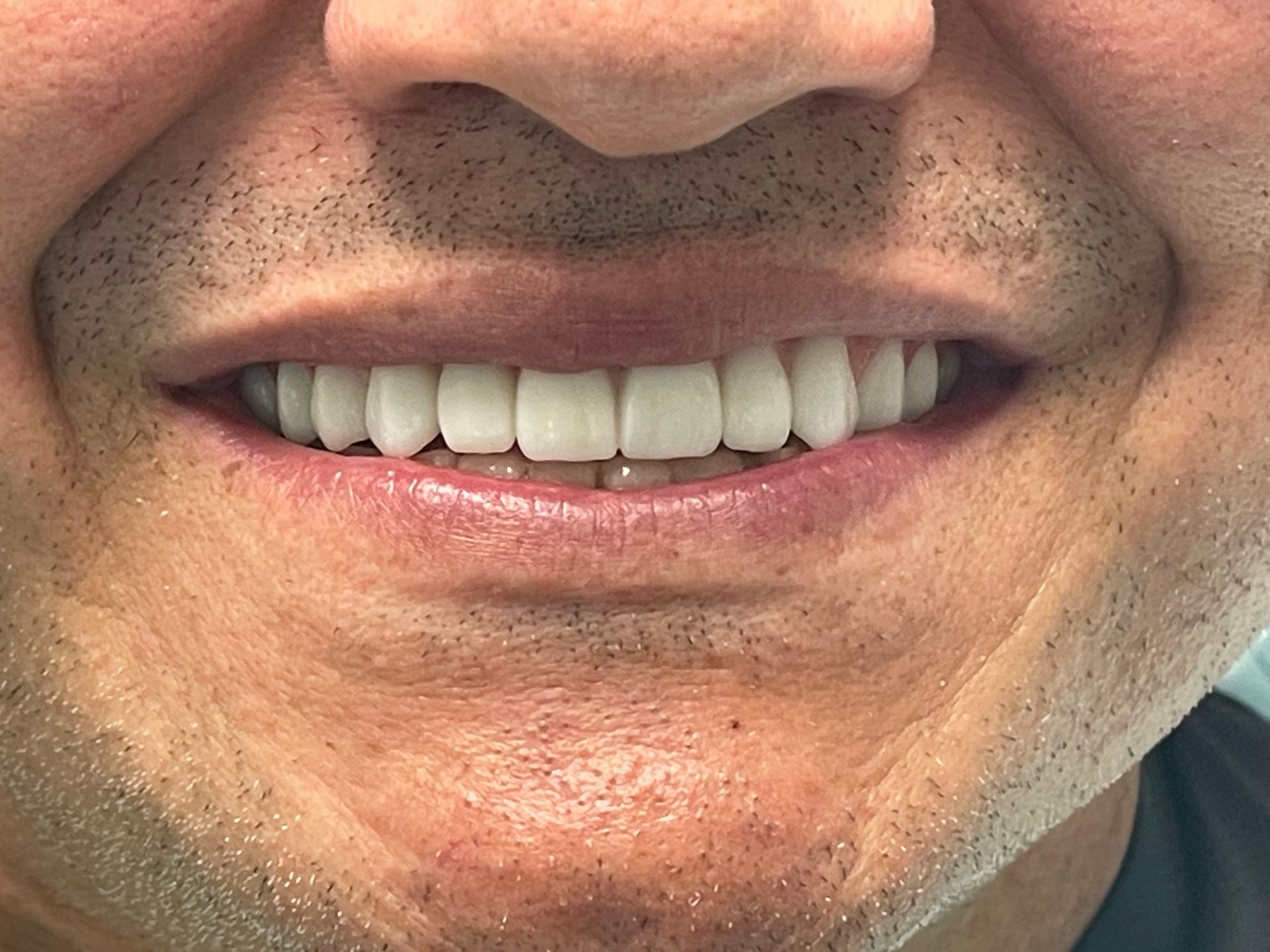 a close up of a man 's mouth with white teeth | all on x | Upper only, full arch dentistry | Before and After Dental Treatment | Barclay Family Dental | Best Dentist For Family Dentistry, Dental Implants, and Cosmetic Dentistry in Cherry Hill, NJ