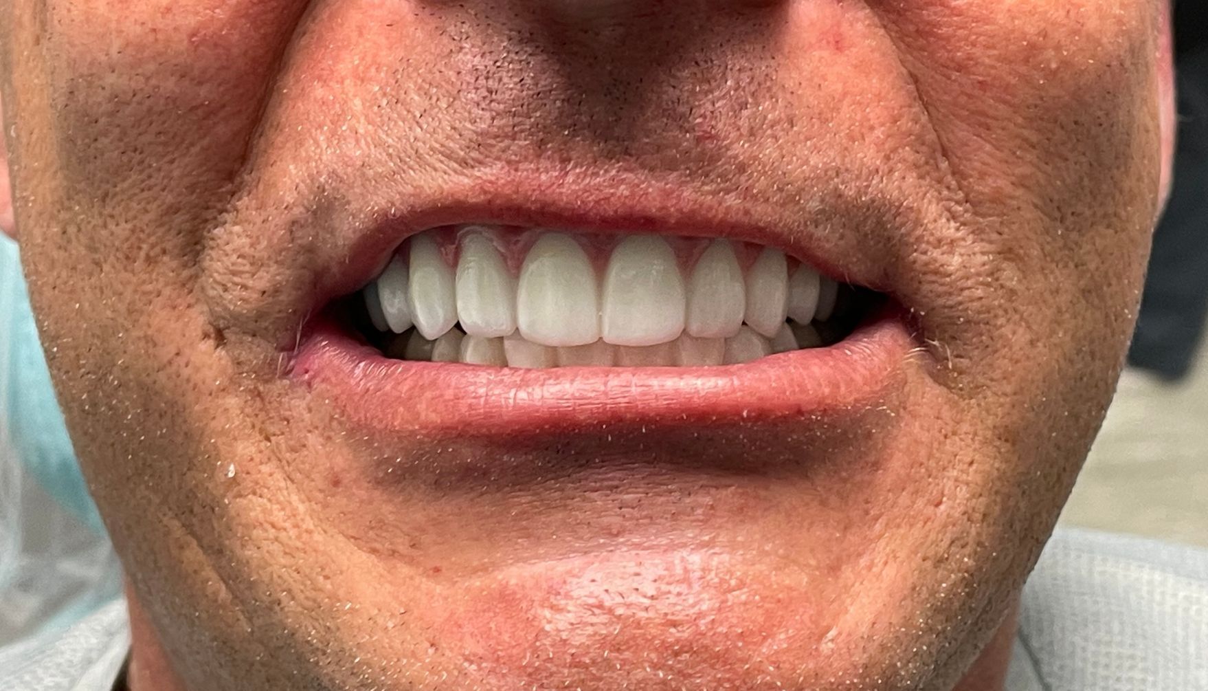 a close up of a man 's mouth with white teeth | All on X - Full Mouth Restoration | Before and After Dental Treatment | Barclay Family Dental | Best Dentist For Family Dentistry, Dental Implants, and Cosmetic Dentistry in Cherry Hill, NJ