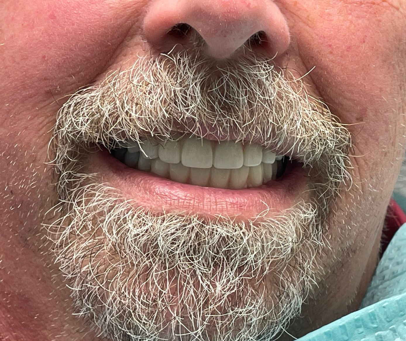 a close up of a man 's mouth with a beard | Before and after dental treatment | All on x dental implants | Full mouth restoration | Barclay Family Dental | Best Dentist For Family Dentistry, Dental Implants, and Cosmetic Dentistry in Cherry Hill, NJ