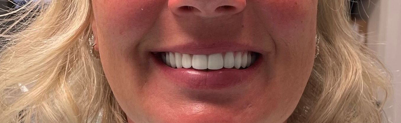 a close up of a woman 's smile with white teeth | All on x | Full arch dental implants of upper teeth only | Full mouth restoration | Smile Makeover | Before and After Dental Treatment | Barclay Family Dental | Best Dentist For Family Dentistry, Dental Implants, and Cosmetic Dentistry in Cherry Hill, NJ