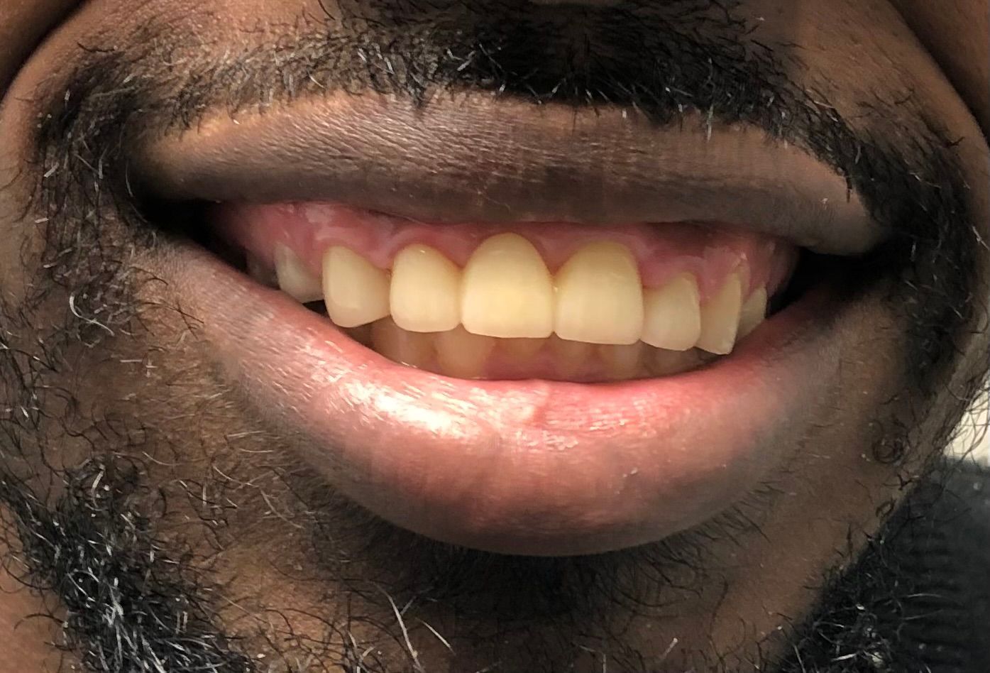 a close up of a man 's teeth with a beard | Anterior bridge | Front Tooth Replacement | Full mouth restoration | Smile Makeover | Before and After Dental Treatment | Barclay Family Dental | Best Dentist For Family Dentistry, Dental Implants, and Cosmetic Dentistry in Cherry Hill, NJ