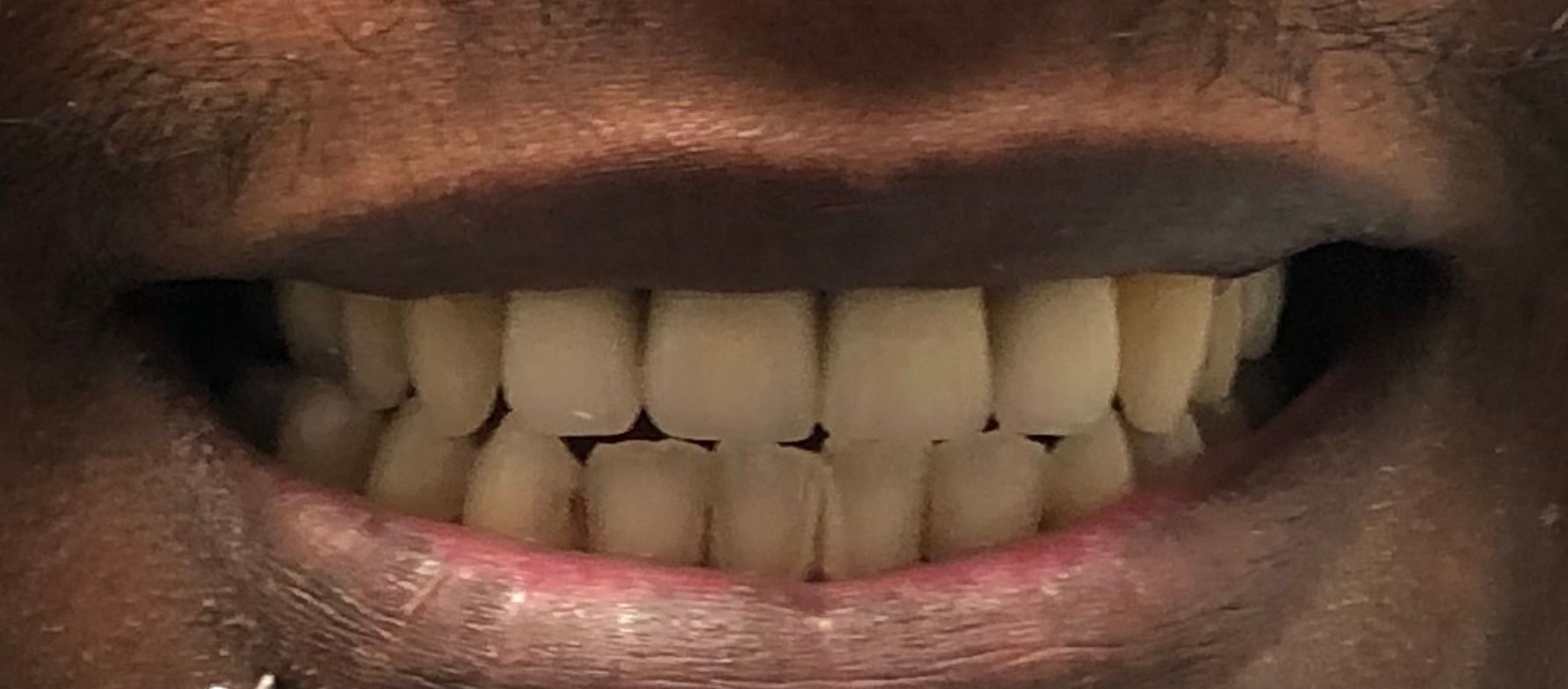 a close up of a person 's mouth showing their teeth | Anterior Crowns | Front Crowns | Full mouth restoration | Smile Makeover | Before and After Dental Treatment | Barclay Family Dental | Best Dentist For Family Dentistry, Dental Implants, and Cosmetic Dentistry in Cherry Hill, NJ