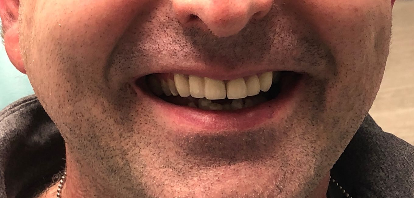 a close up of a man 's mouth with his teeth showing | Dental Crowns and Dental Bridge | Full mouth restoration | Smile Makeover | Before and After Dental Treatment | Barclay Family Dental | Best Dentist For Family Dentistry, Dental Implants, and Cosmetic Dentistry in Cherry Hill, NJ
