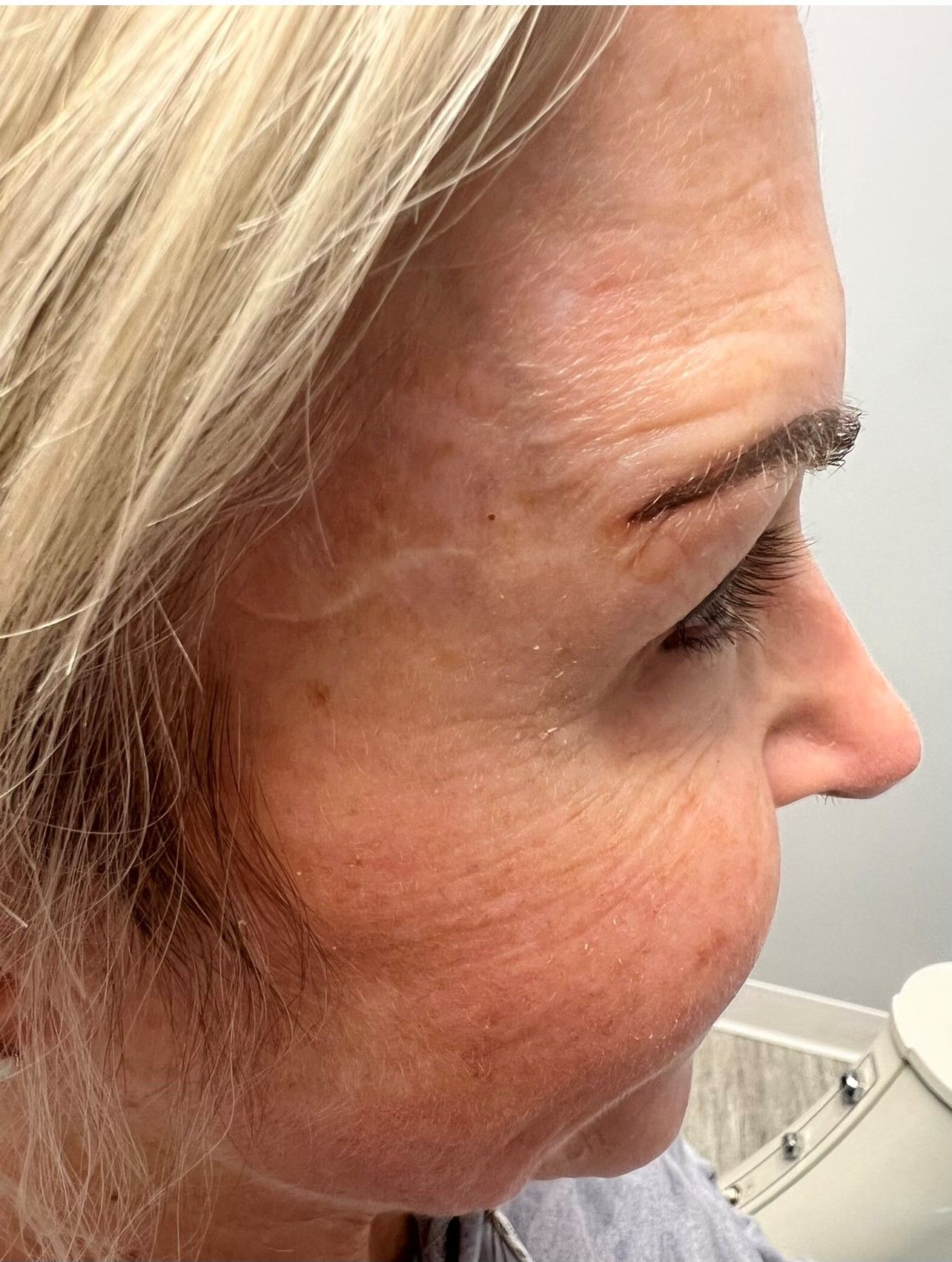 a close up of a woman 's face with wrinkles | Botox Treatment | Cosmetic D