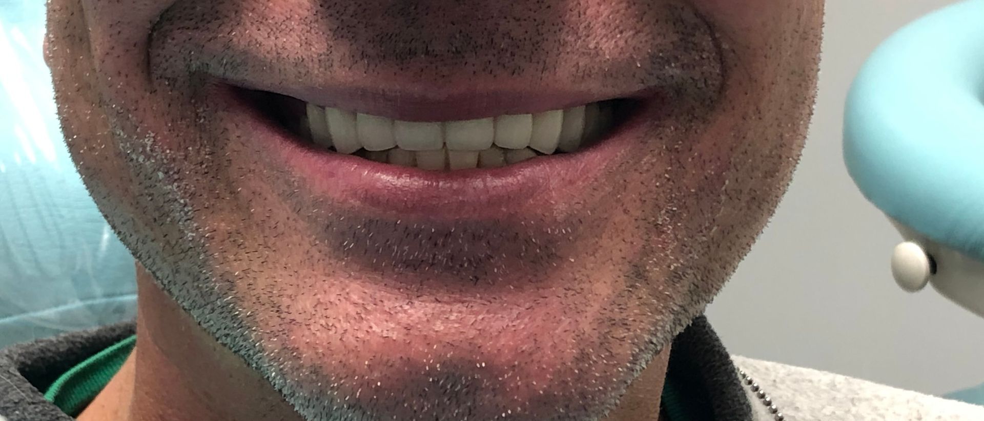 a close up of a man 's face with a smile on his face | Full mouth dental crowns | Full mouth restoration | Smile Makeover | Before and After Dental Treatment | Barclay Family Dental | Best Dentist For Family Dentistry, Dental Implants, and Cosmetic Dentistry in Cherry Hill, NJ