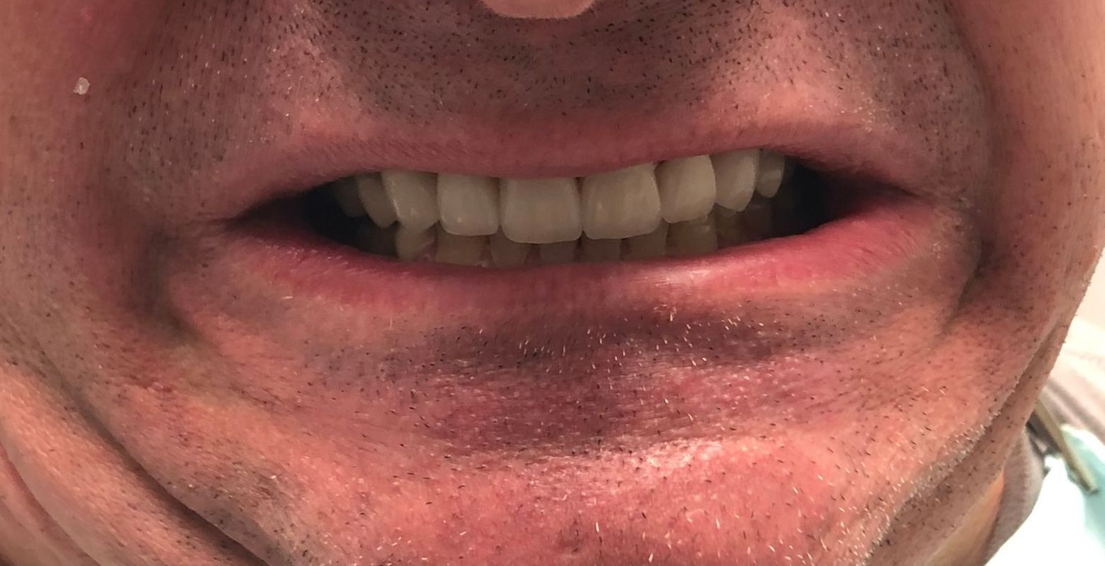 Full mouth restoration | Smile Makeover | Before and After Dental Treatment | Barclay Family Dental | Best Dentist For Family Dentistry, Dental Implants, and Cosmetic Dentistry in Cherry Hill, NJ
