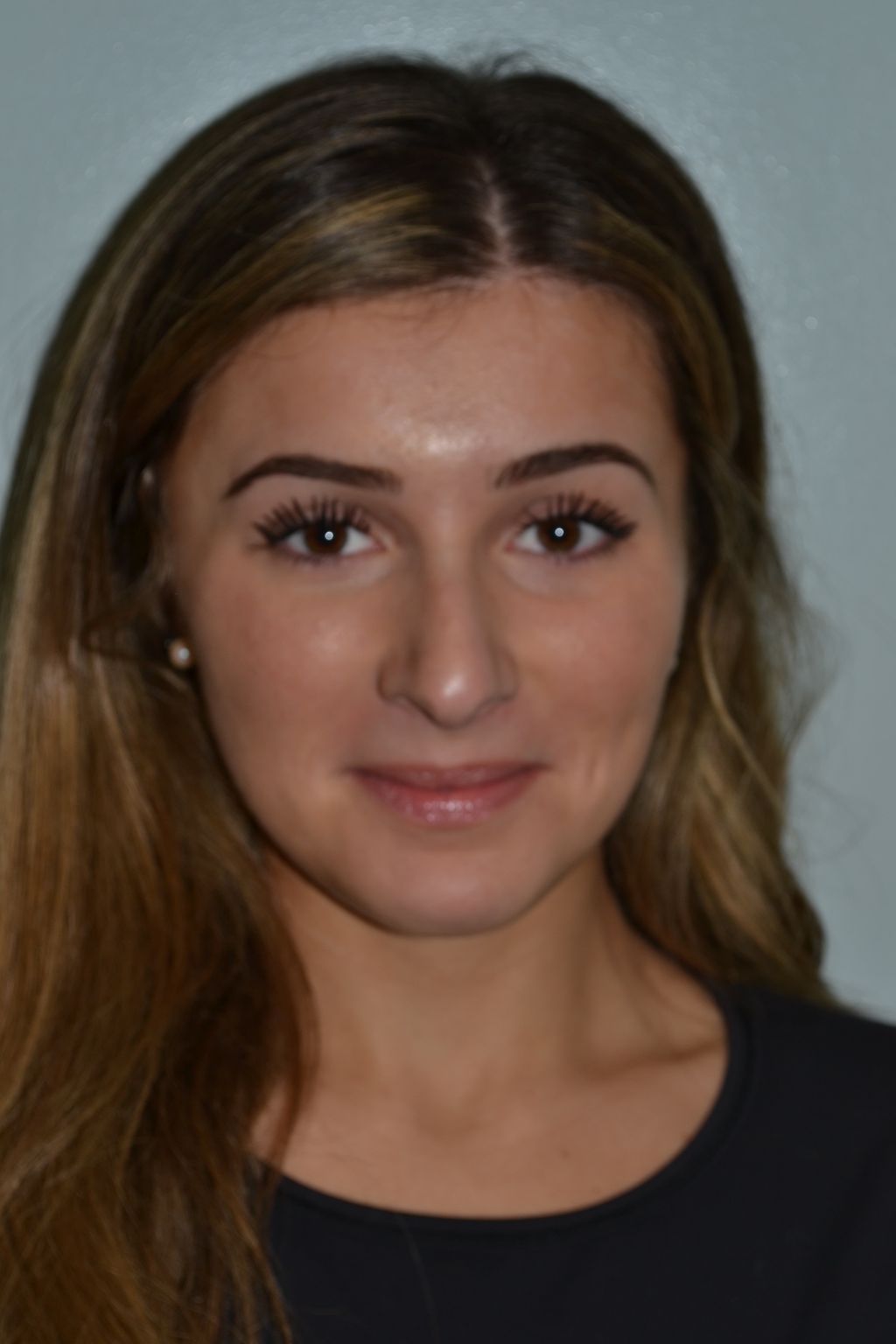 Rhinoplasty Procedure 13 — North Shore Facial Plastic Surgery —  Danvers, MA