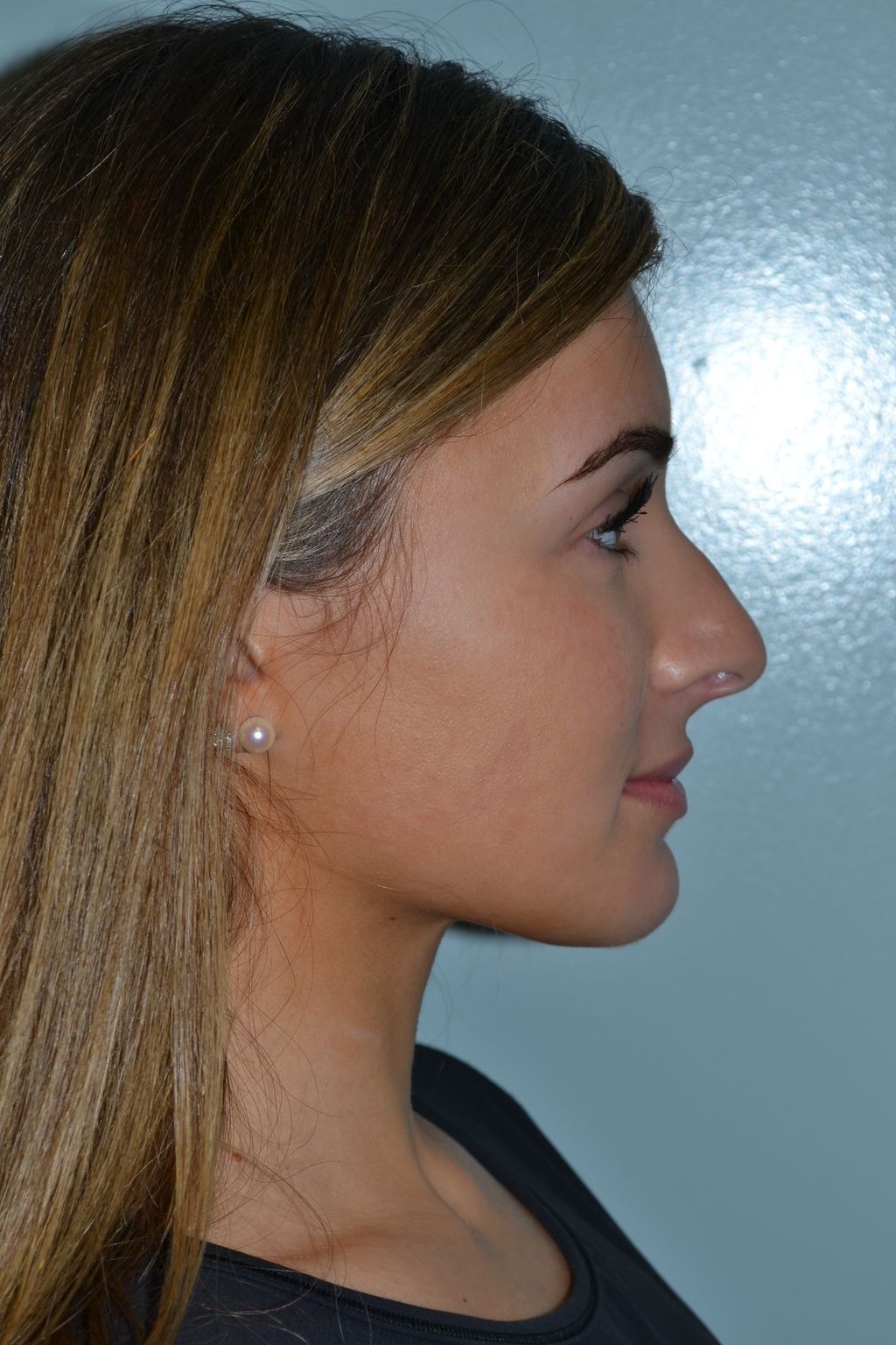 Rhinoplasty Procedure 11 — North Shore Facial Plastic Surgery —  Danvers, MA