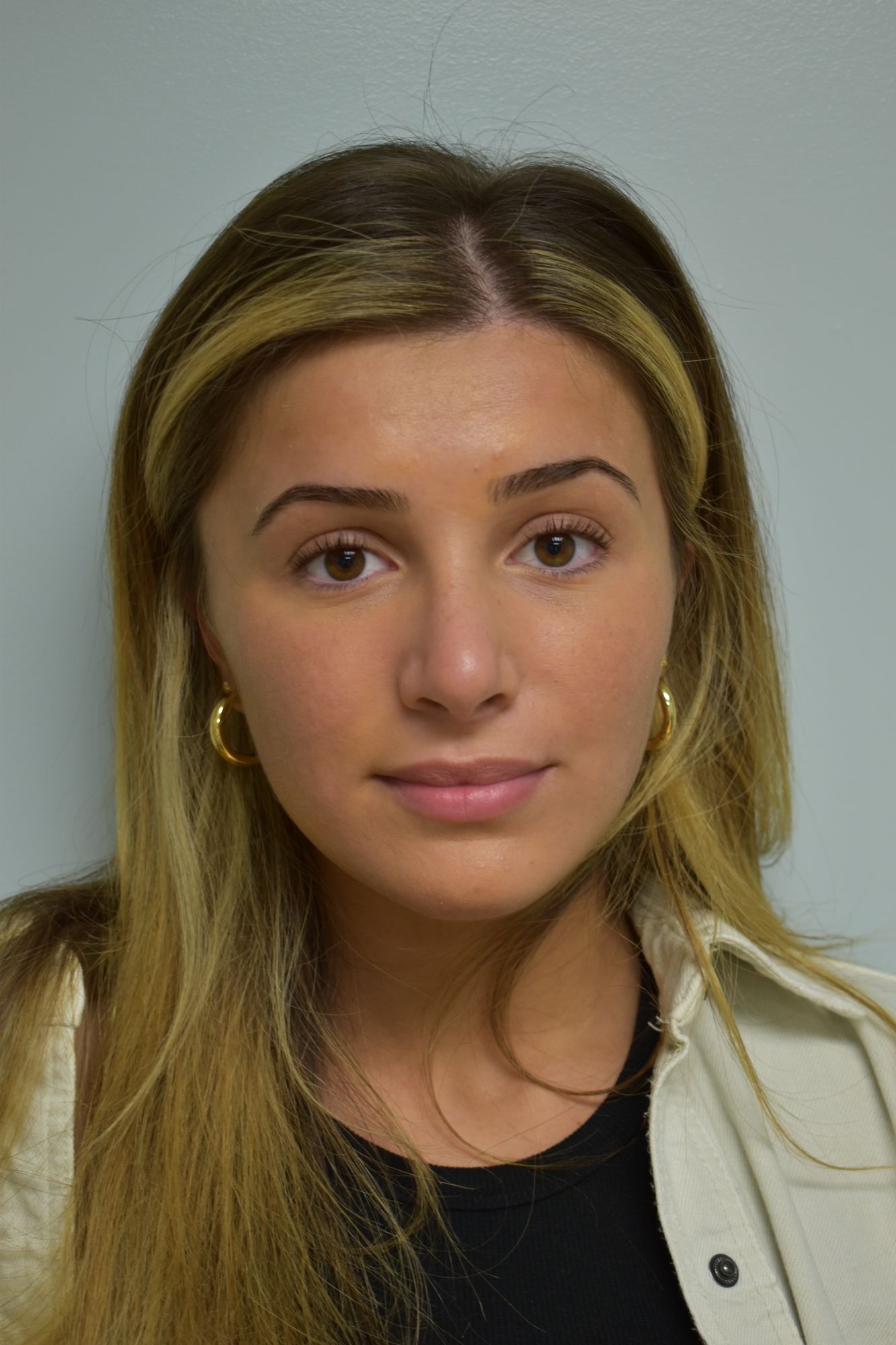 Rhinoplasty Procedure 14 — North Shore Facial Plastic Surgery —  Danvers, MA