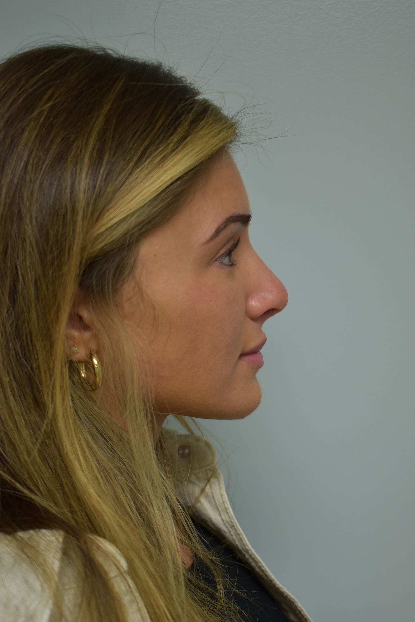 Rhinoplasty Procedure 12 — North Shore Facial Plastic Surgery —  Danvers, MA