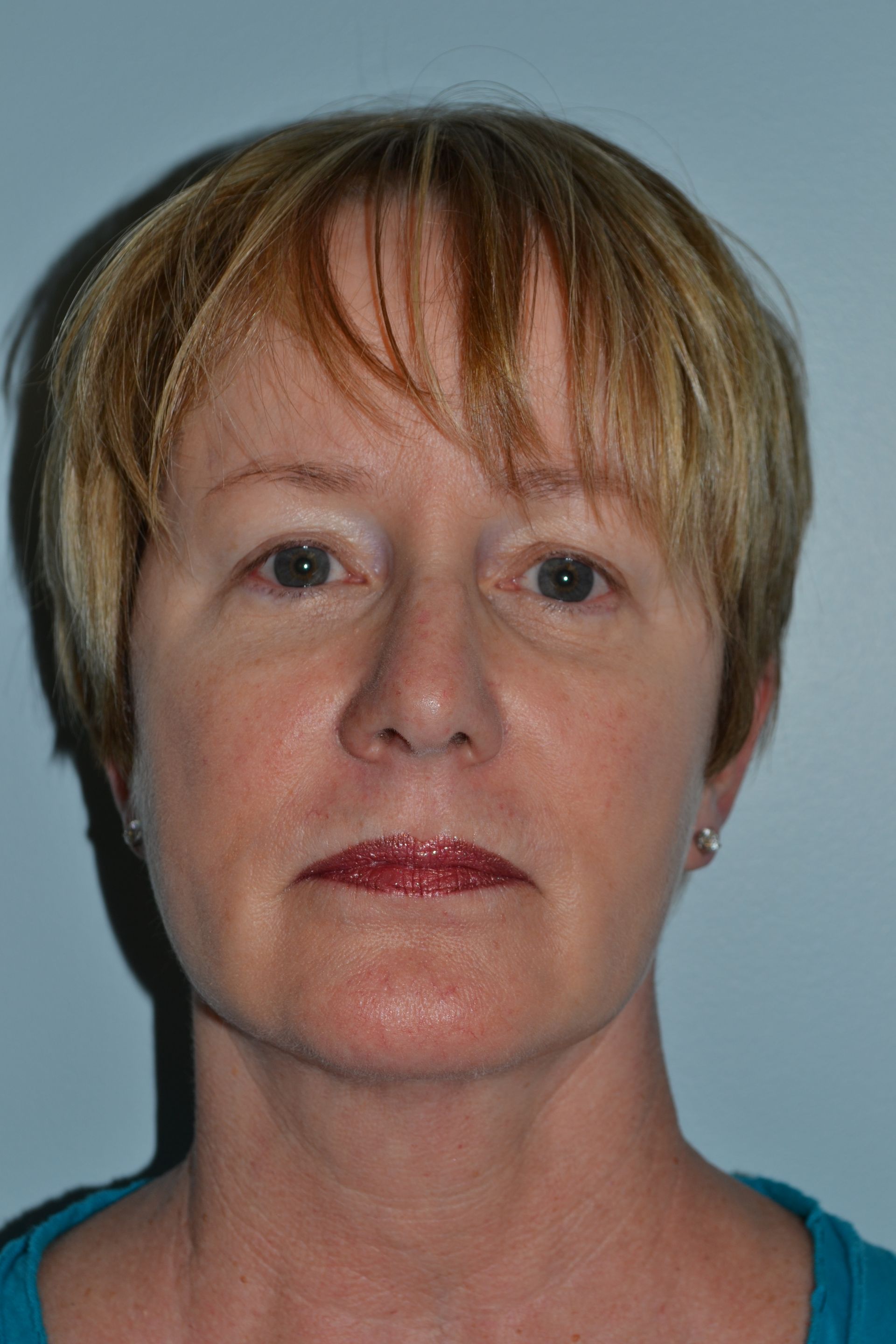 Facelifts Procedure 6 — North Shore Facial Plastic Surgery —  Danvers, MA