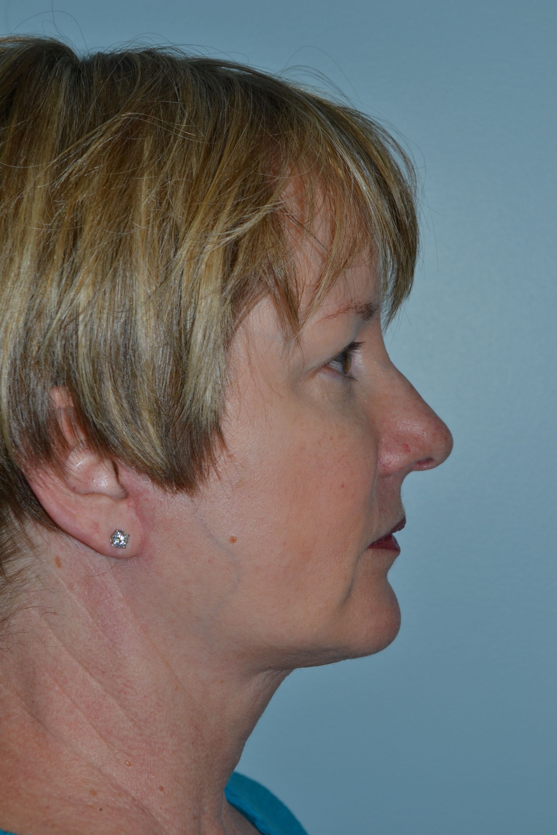 Facelifts Procedure 6 — North Shore Facial Plastic Surgery —  Danvers, MA
