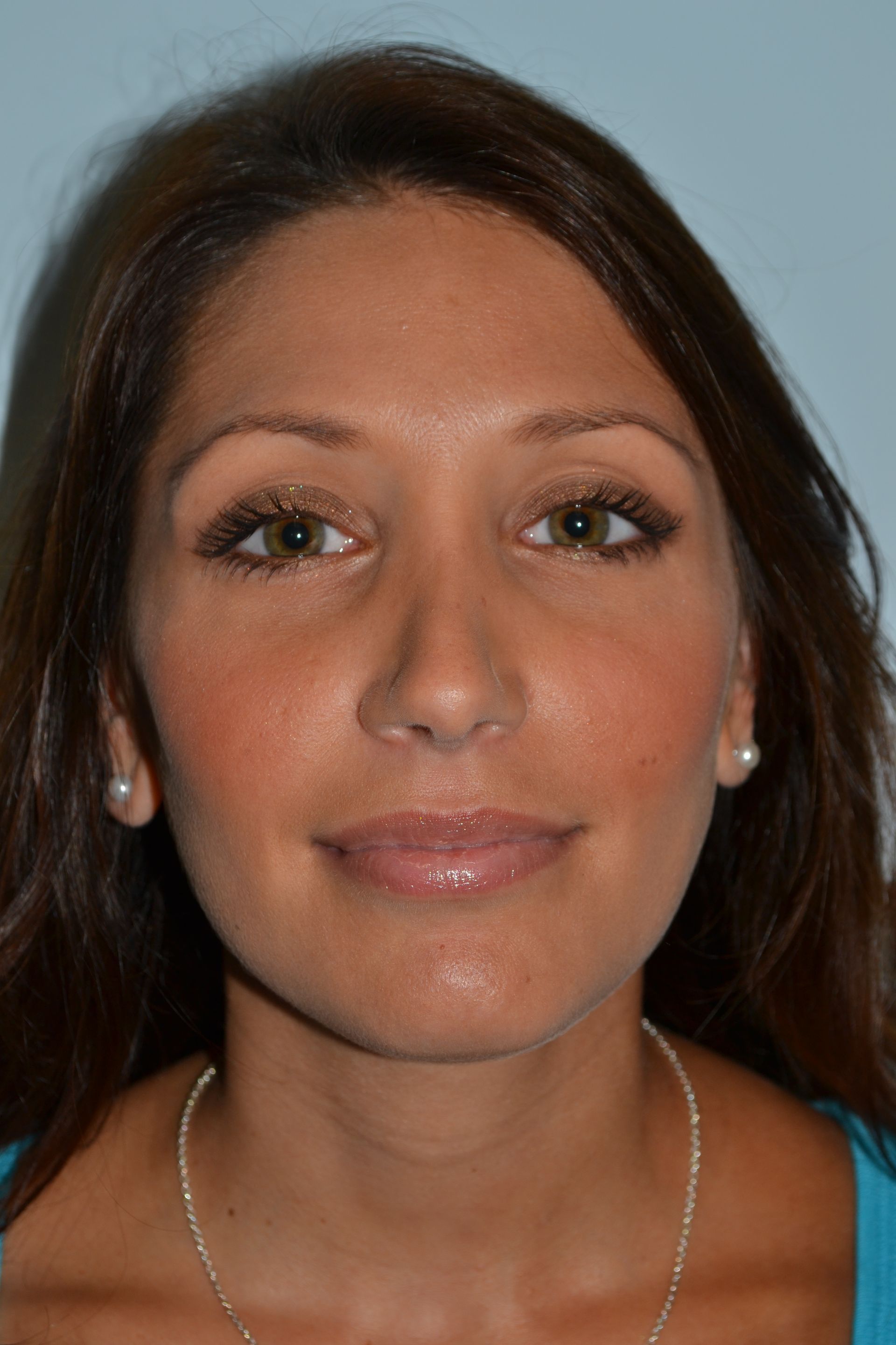 Rhinoplasty Procedure 1 — North Shore Facial Plastic Surgery —  Danvers, MA