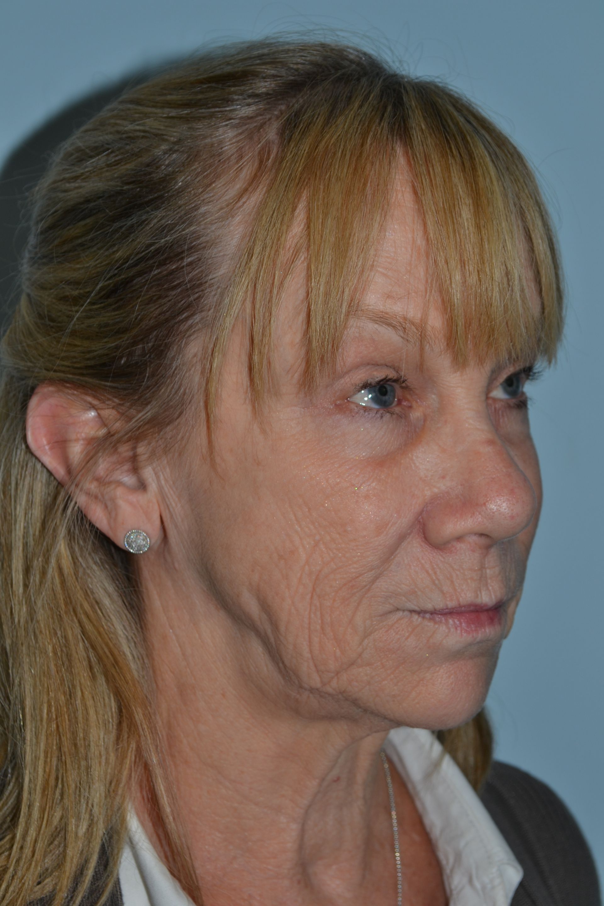 Facelifts Procedure 1 — North Shore Facial Plastic Surgery —  Danvers, MA