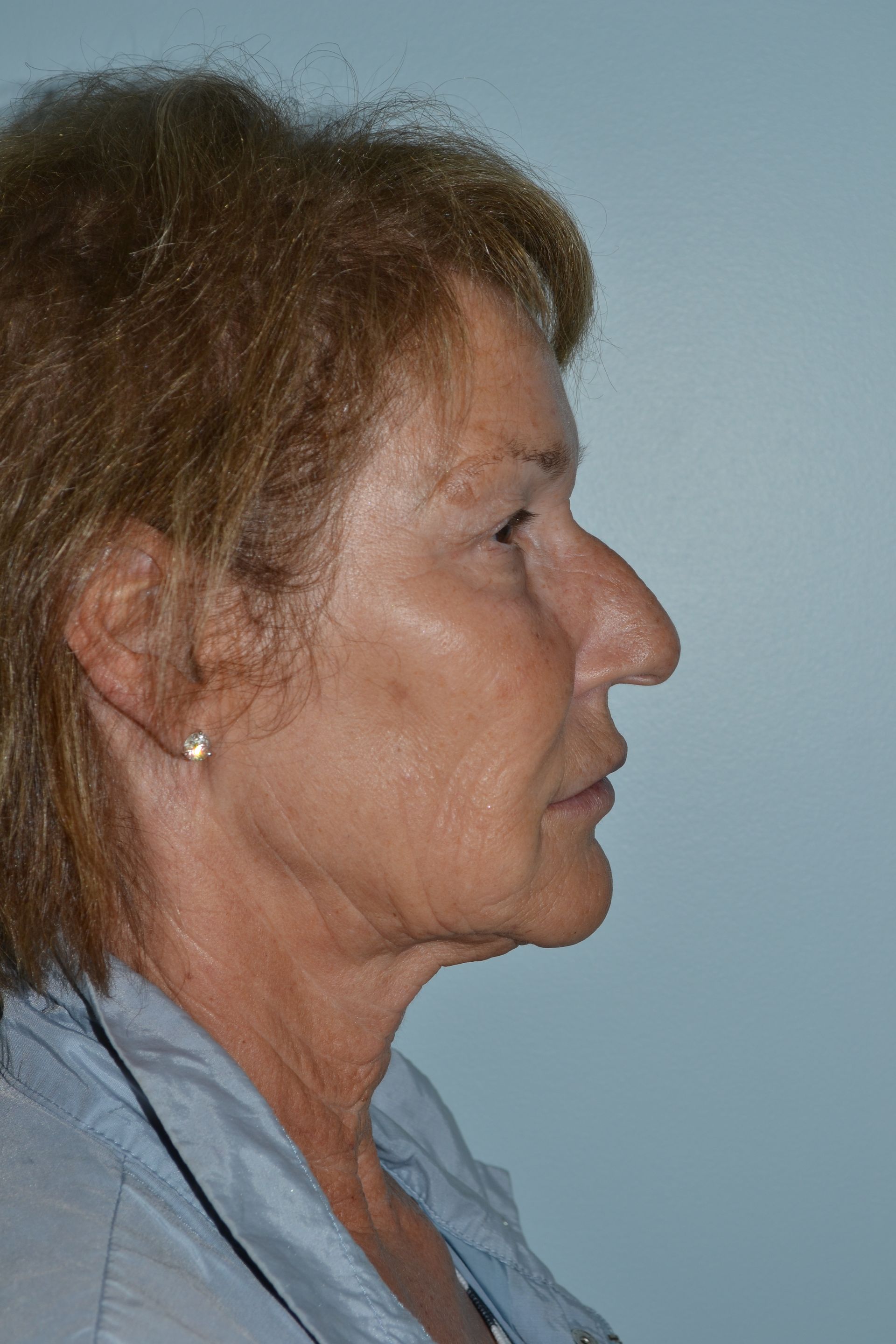 Facelifts Procedure 3 — North Shore Facial Plastic Surgery —  Danvers, MA
