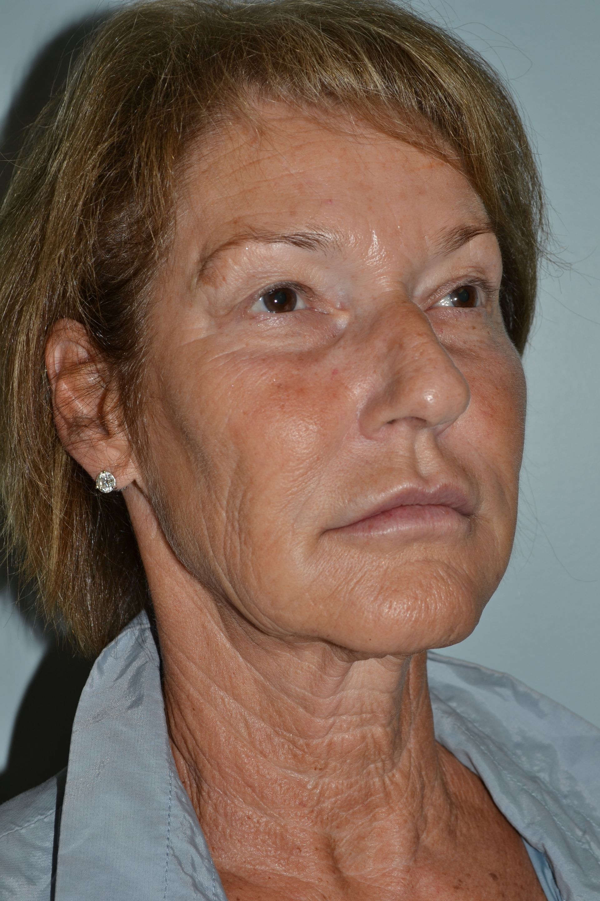 Facelifts Procedure 7 — North Shore Facial Plastic Surgery —  Danvers, MA