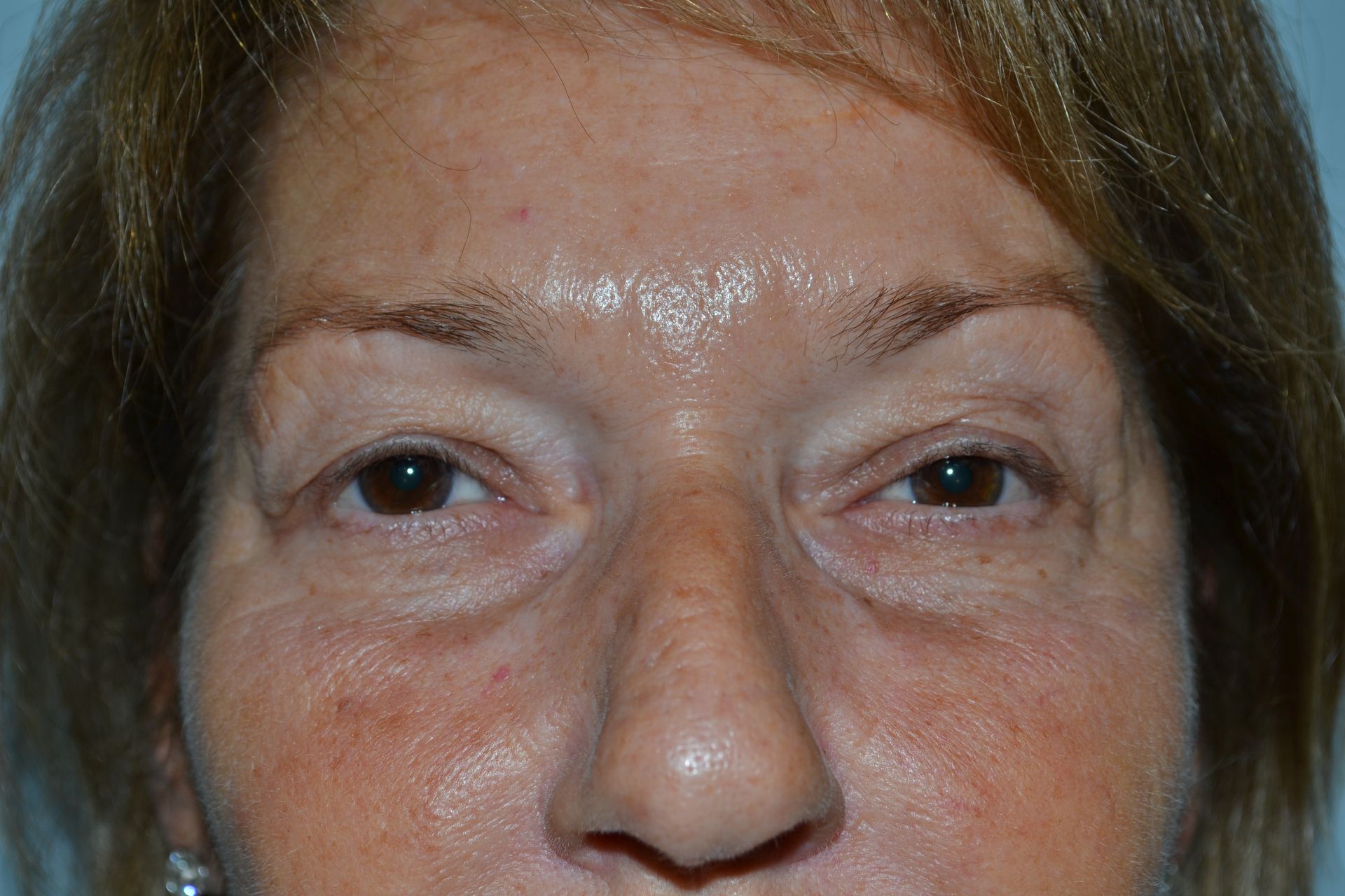 Blepharoplasty Procedure 6 — North Shore Facial Plastic Surgery —  Danvers, MA