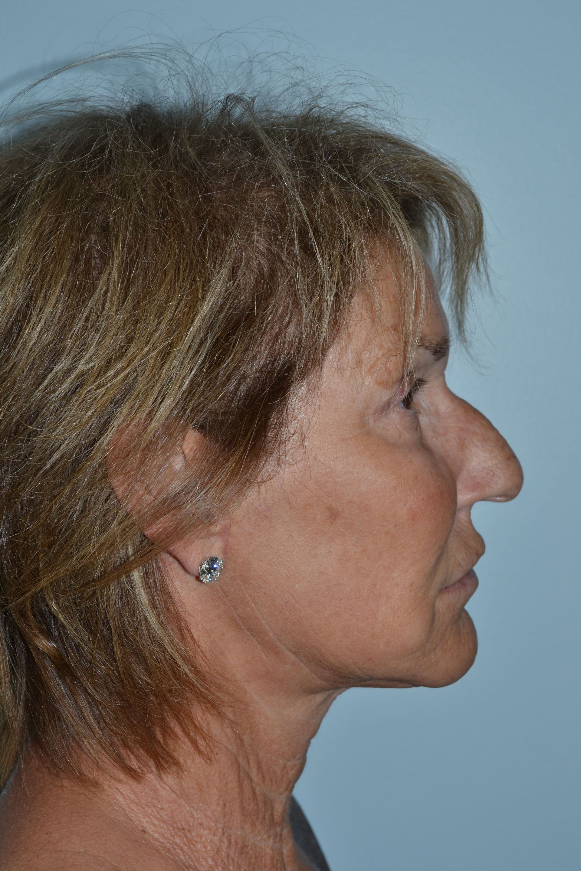 Facelifts Procedure 4 — North Shore Facial Plastic Surgery —  Danvers, MA