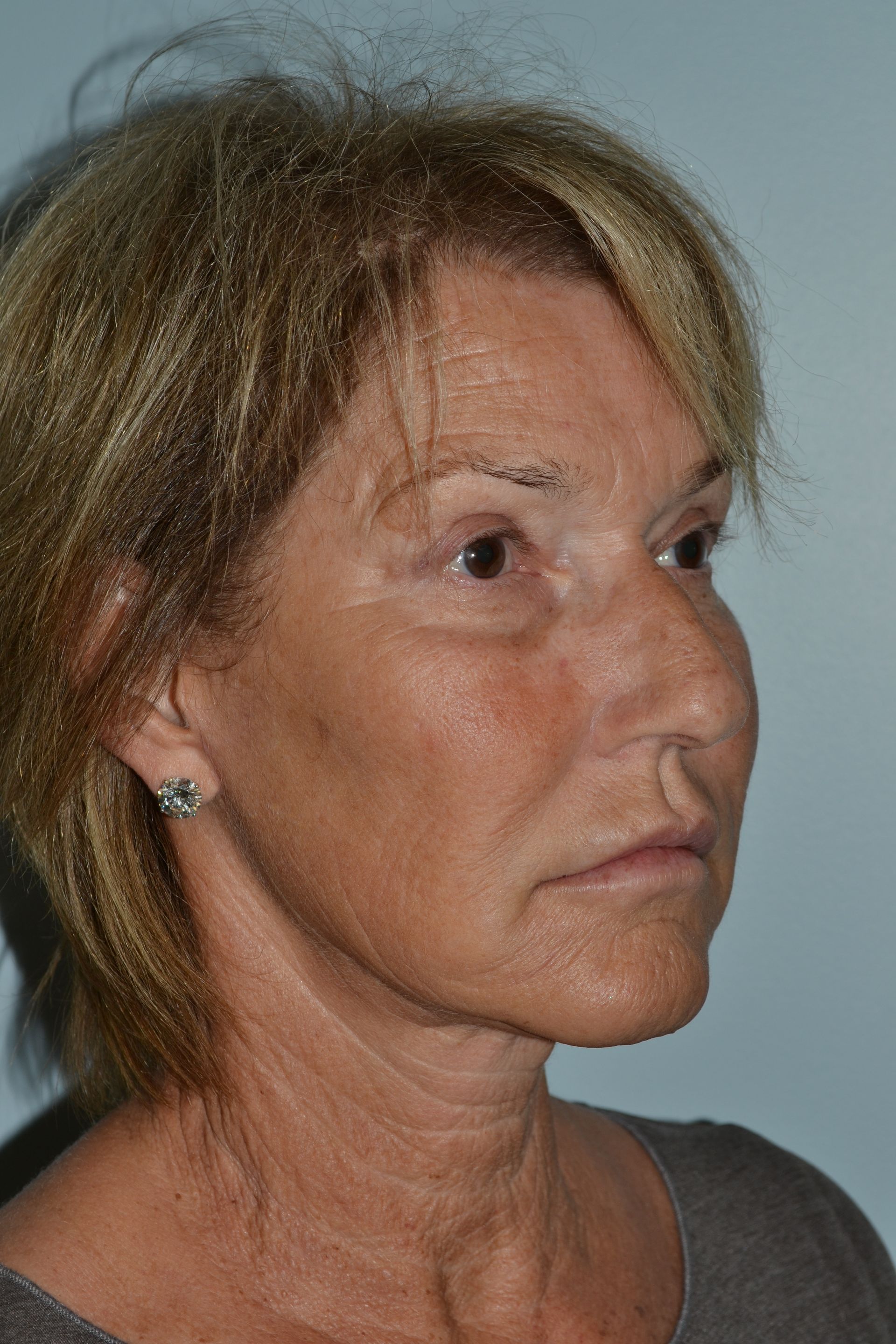 Facelifts Procedure 8 — North Shore Facial Plastic Surgery —  Danvers, MA