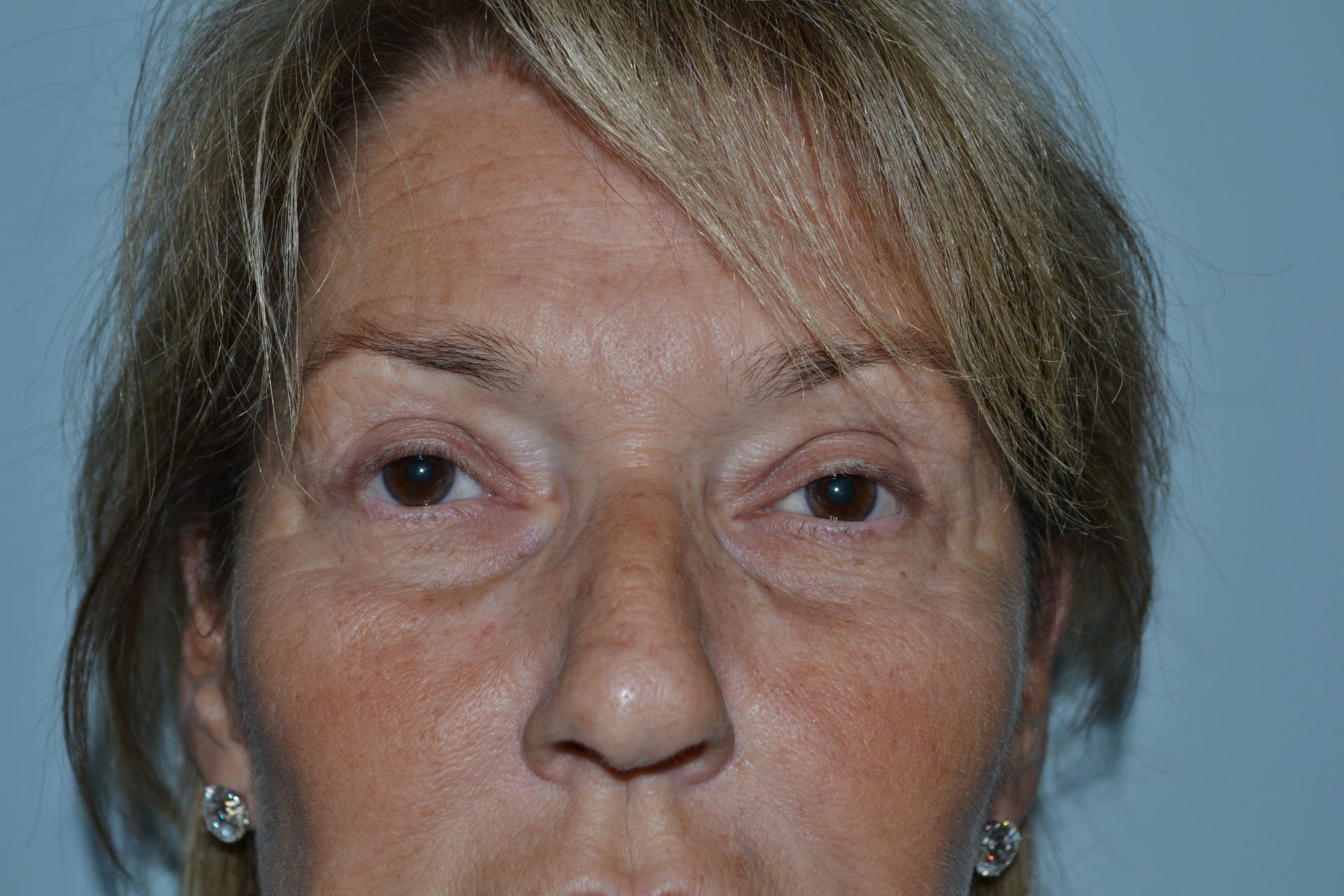 Blepharoplasty Procedure 5 — North Shore Facial Plastic Surgery —  Danvers, MA
