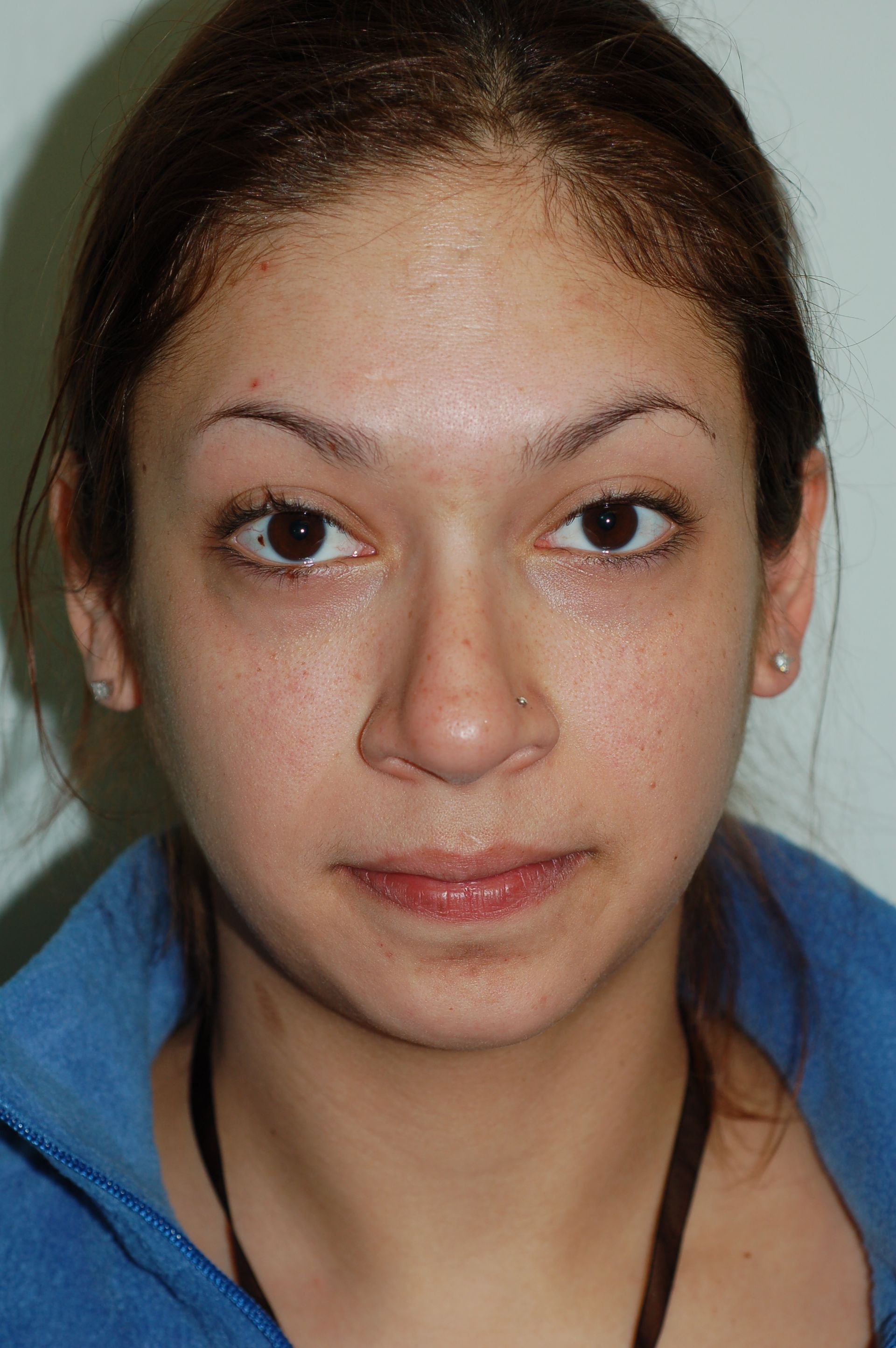 Rhinoplasty Procedure 15 — North Shore Facial Plastic Surgery —  Danvers, MA