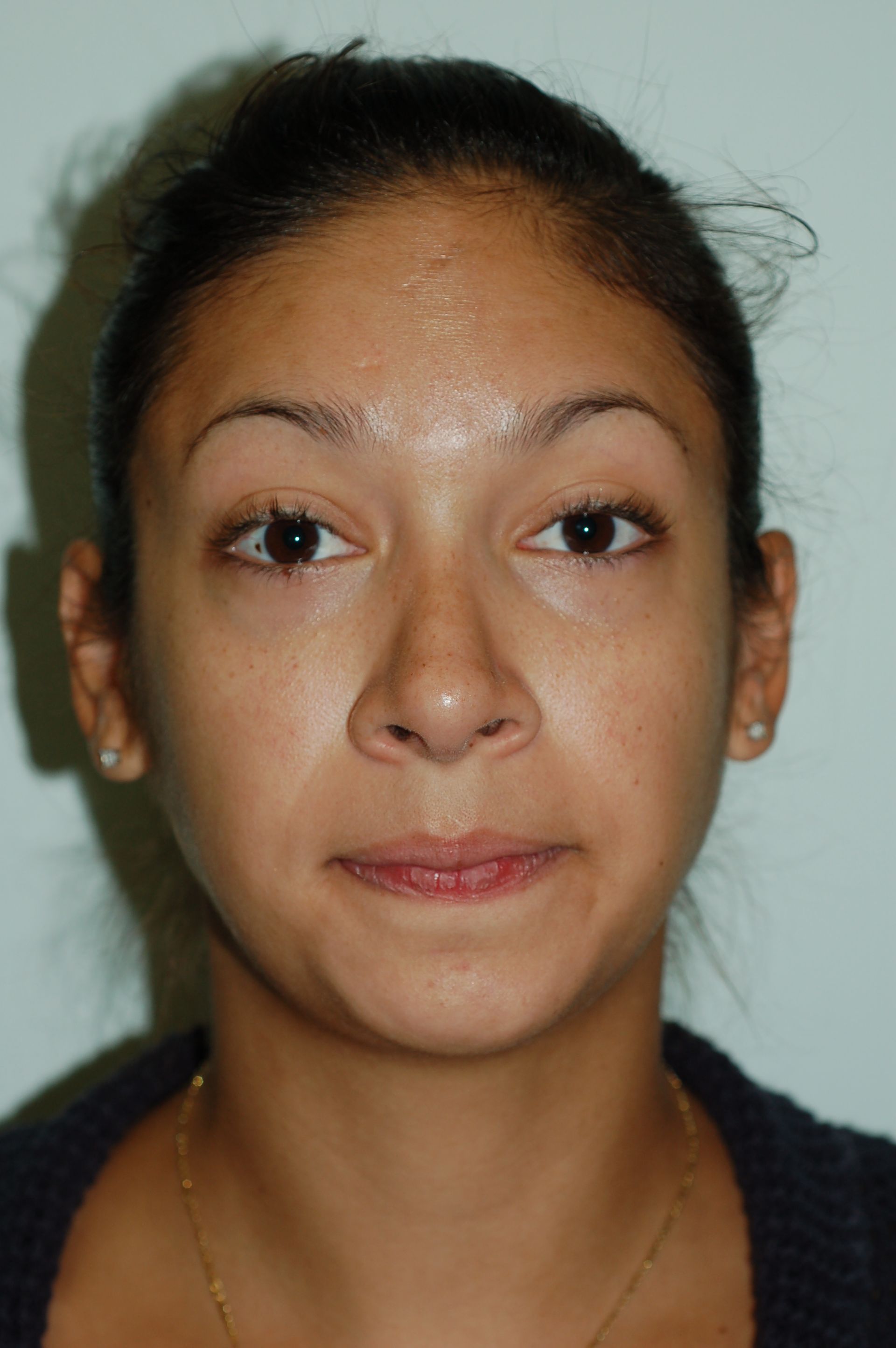 Rhinoplasty Procedure 16 — North Shore Facial Plastic Surgery —  Danvers, MA