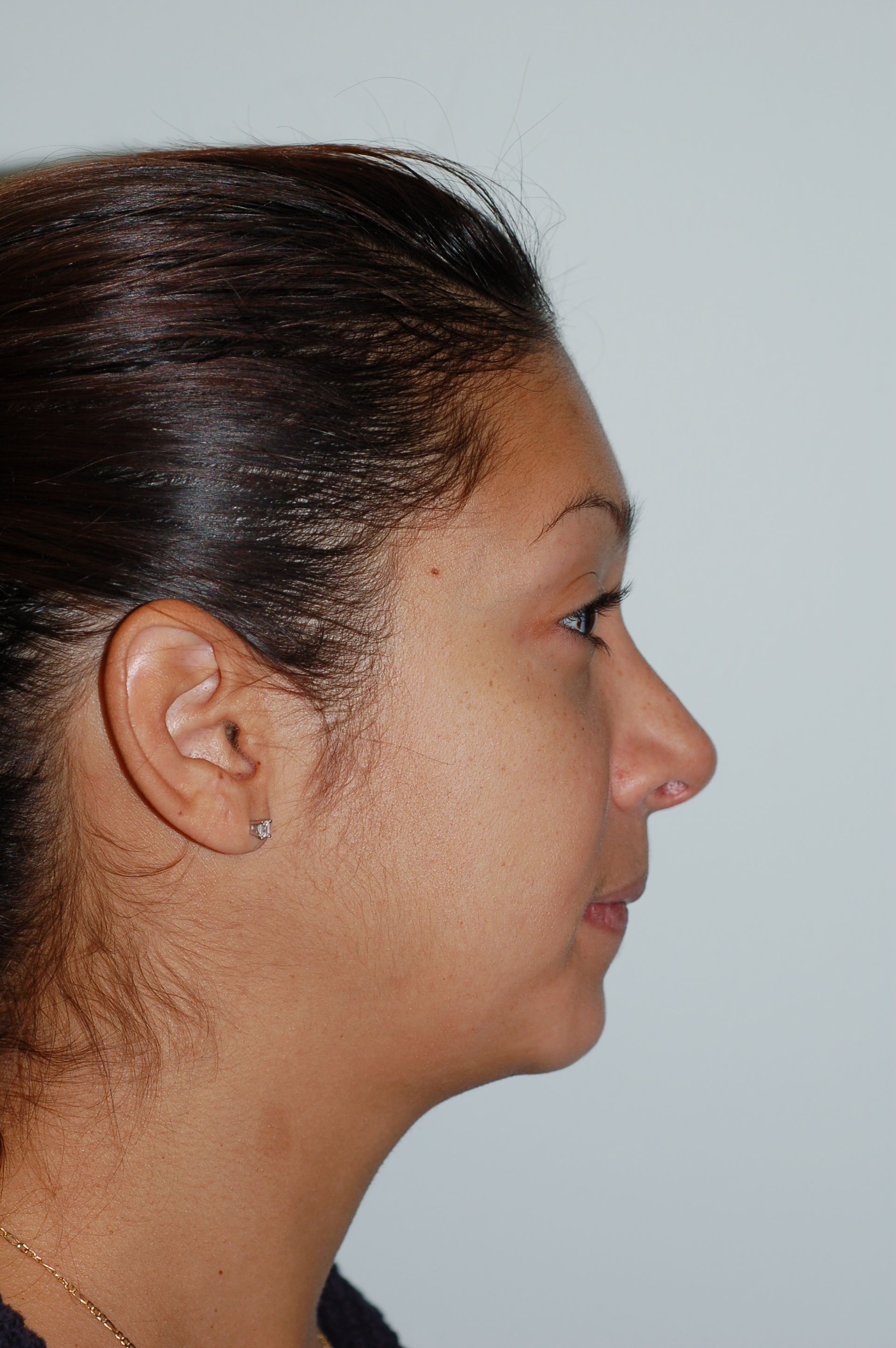 Rhinoplasty Procedure 18 — North Shore Facial Plastic Surgery —  Danvers, MA