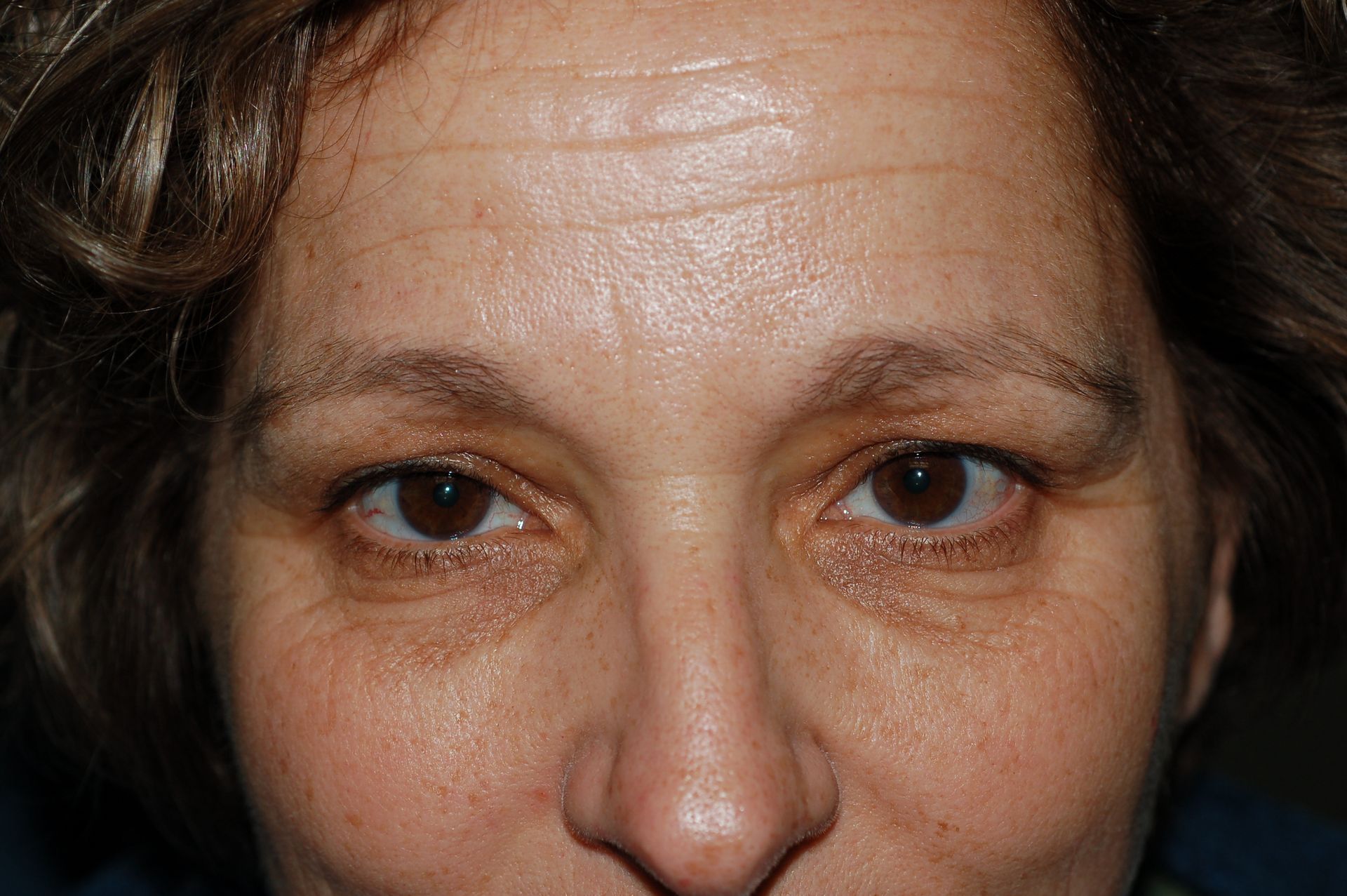 Blepharoplasty Procedure 1 — North Shore Facial Plastic Surgery —  Danvers, MA