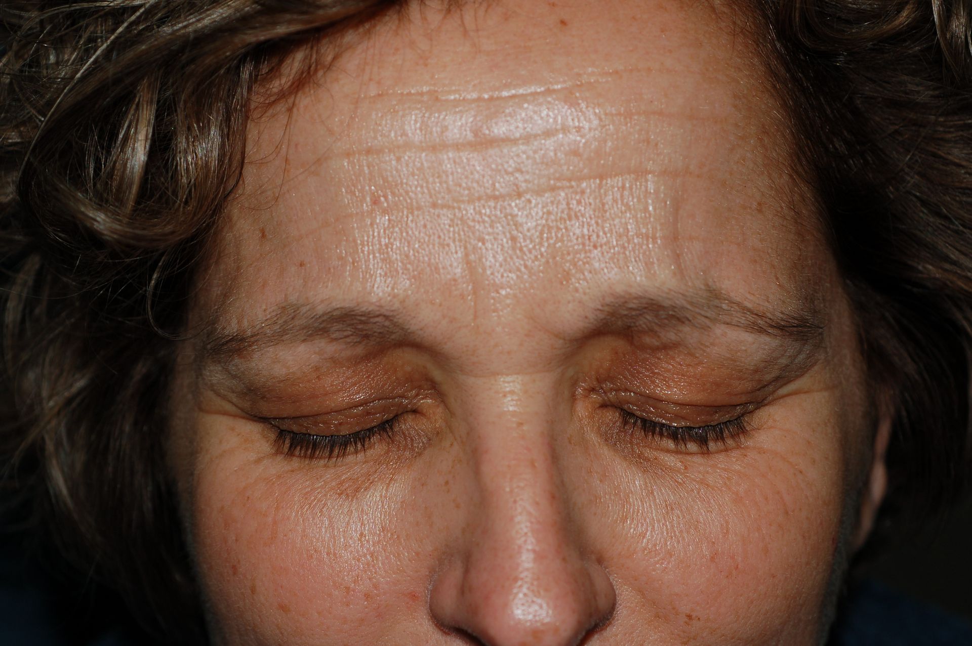 Blepharoplasty Procedure 3 — North Shore Facial Plastic Surgery —  Danvers, MA