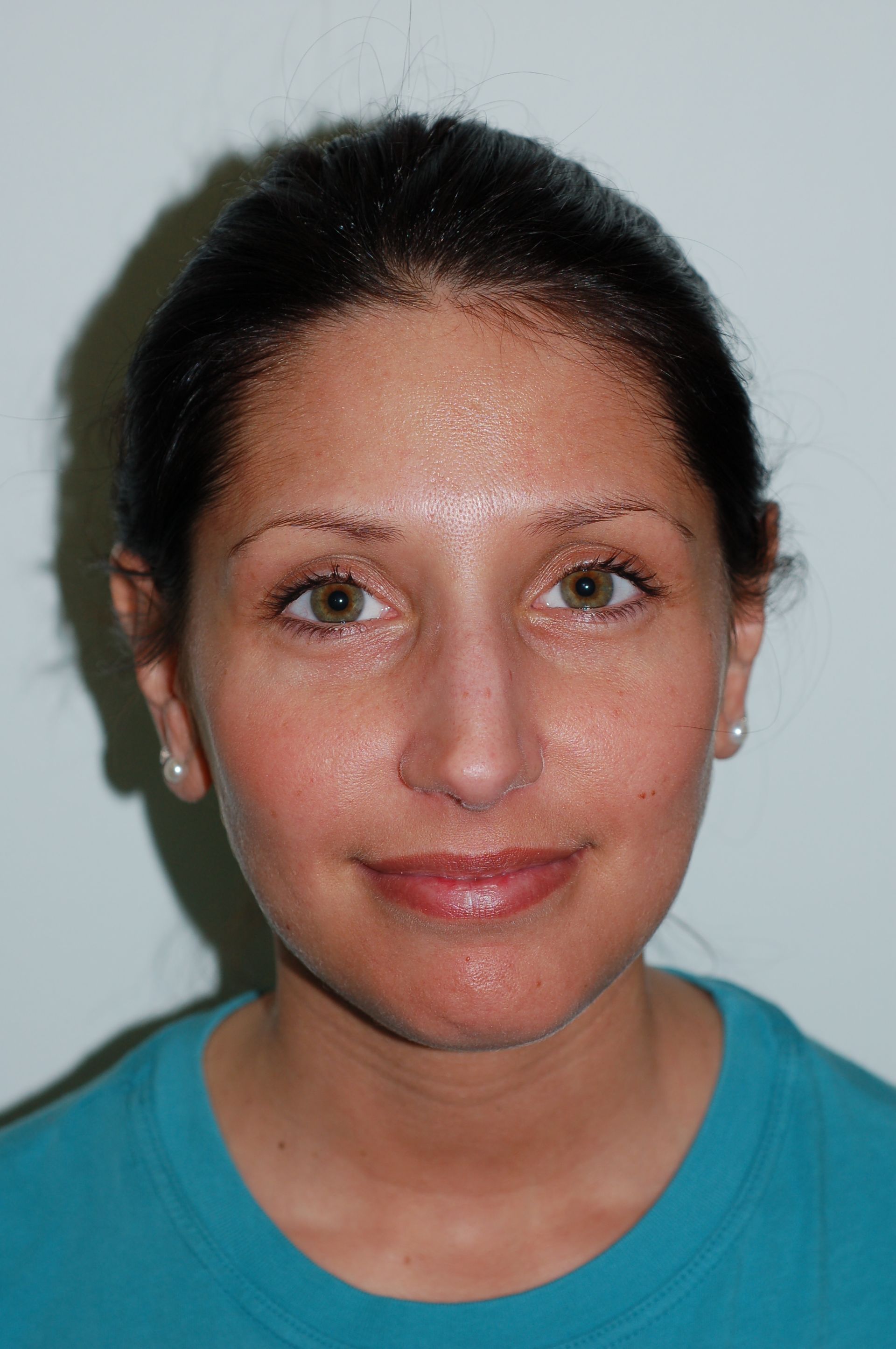 Rhinoplasty Procedure 2 — North Shore Facial Plastic Surgery —  Danvers, MA