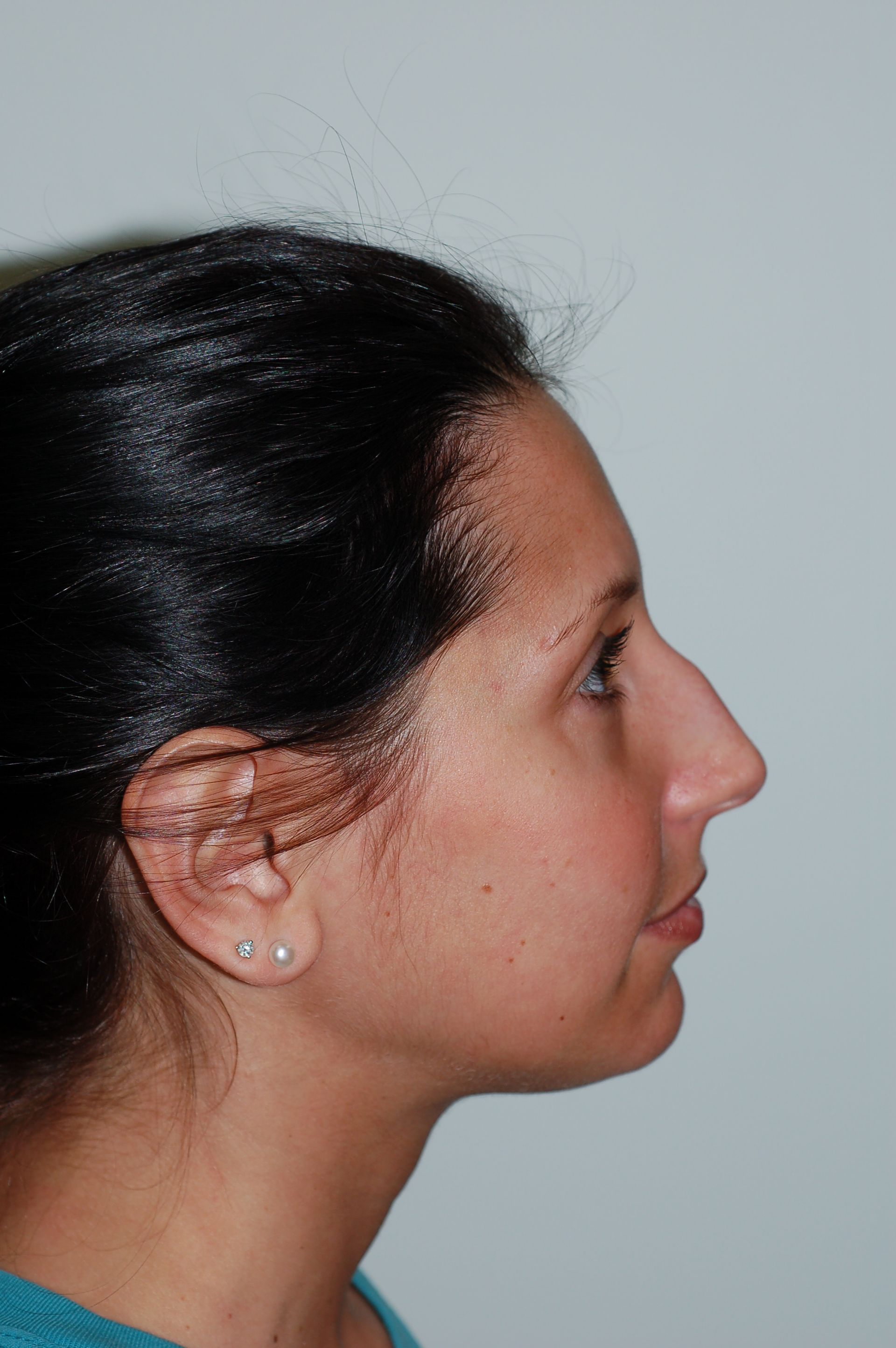 Rhinoplasty Procedure 1 — North Shore Facial Plastic Surgery —  Danvers, MA