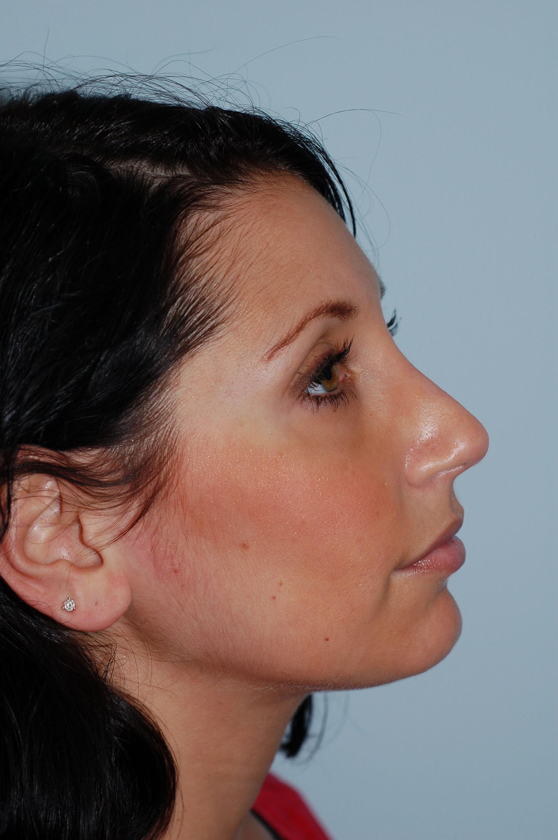 Rhinoplasty Procedure 2 — North Shore Facial Plastic Surgery —  Danvers, MA