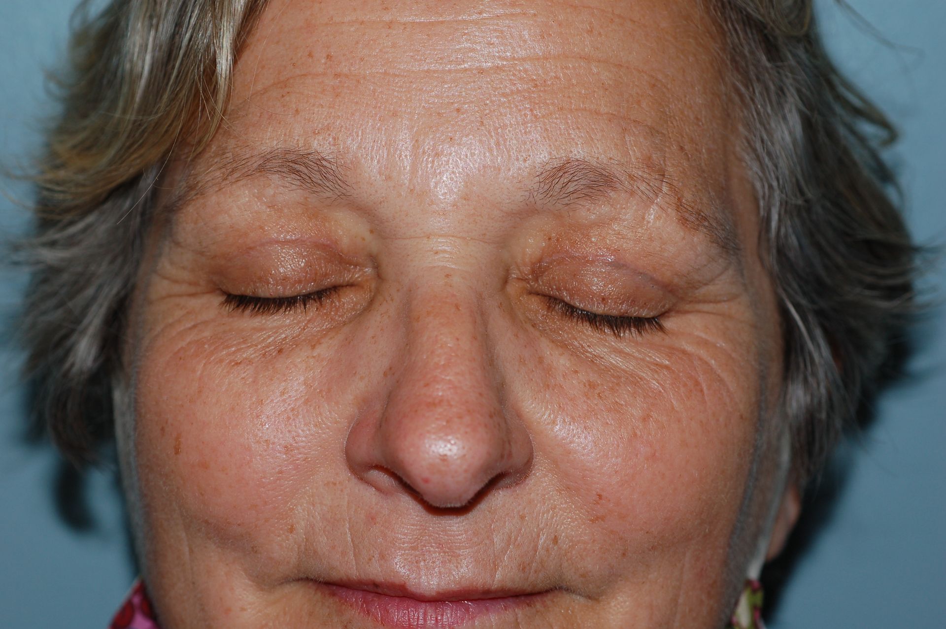 Blepharoplasty Procedure 4 — North Shore Facial Plastic Surgery —  Danvers, MA