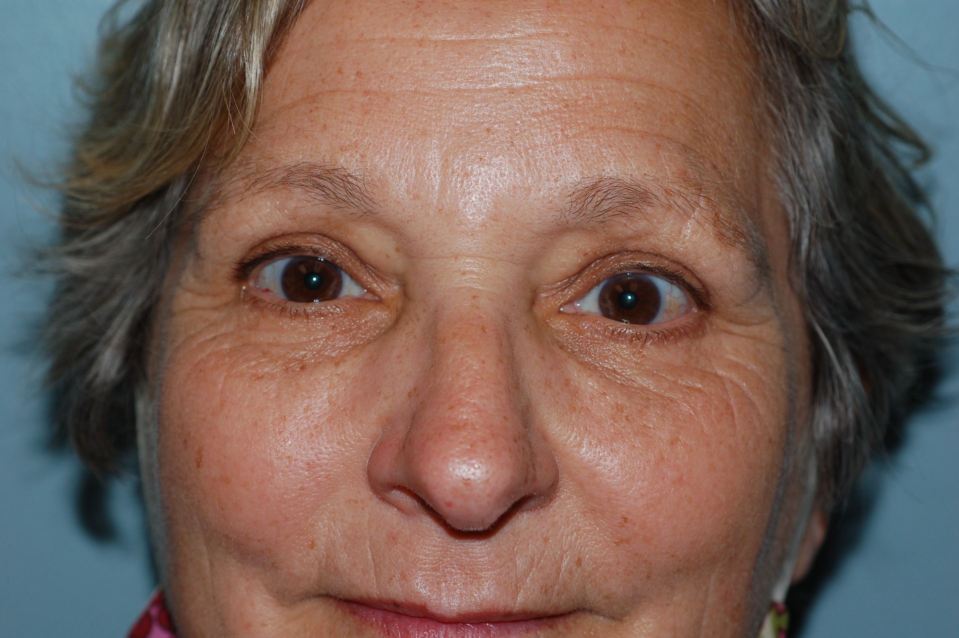 Blepharoplasty Procedure 2 — North Shore Facial Plastic Surgery —  Danvers, MA