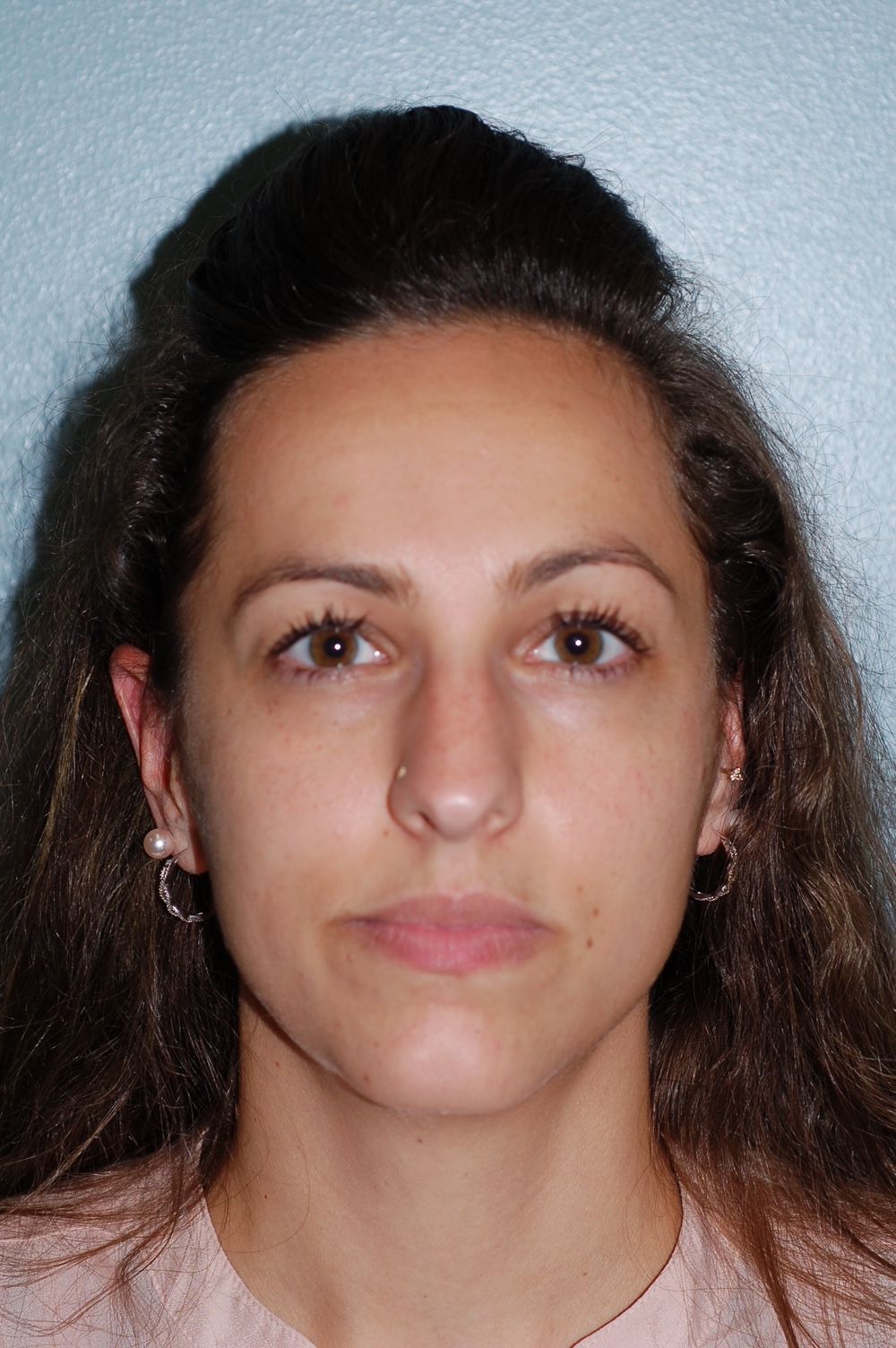 Rhinoplasty Procedure 5 — North Shore Facial Plastic Surgery —  Danvers, MA