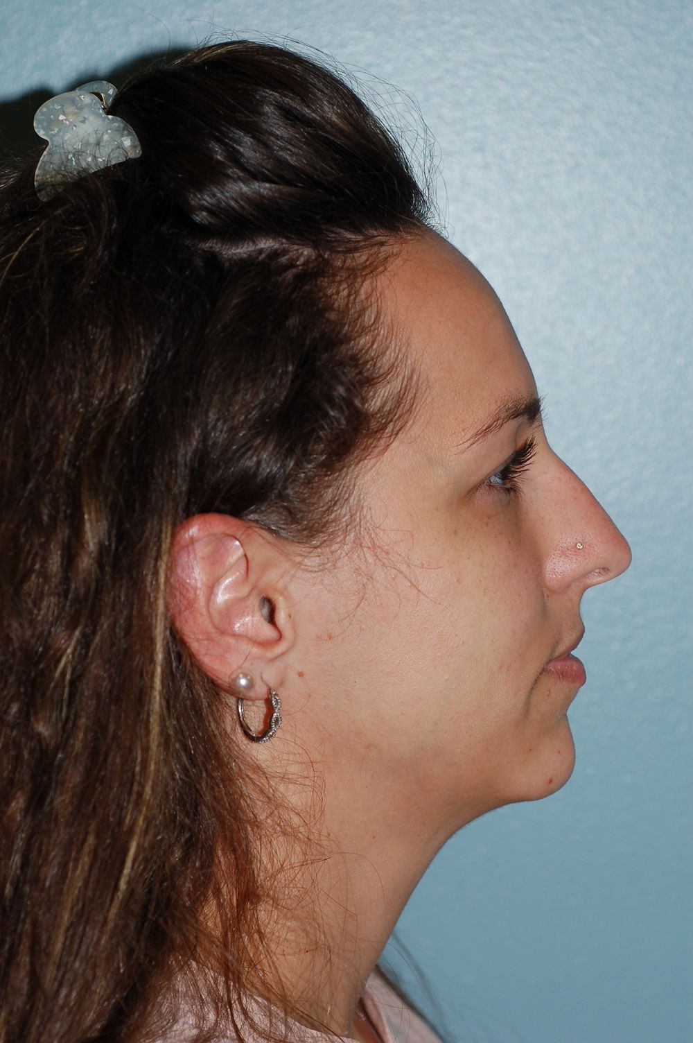 Rhinoplasty Procedure 3 — North Shore Facial Plastic Surgery —  Danvers, MA