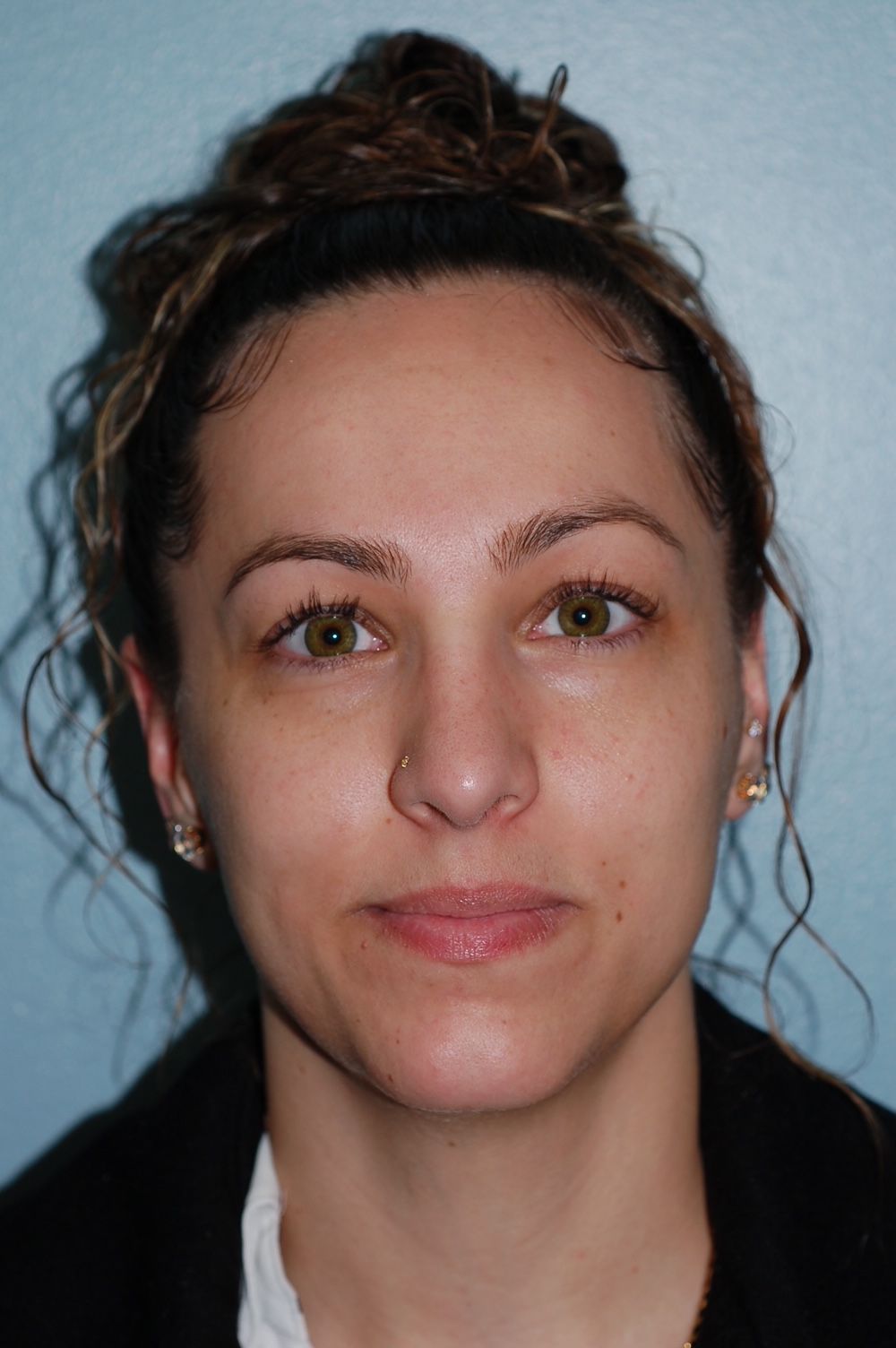 Rhinoplasty Procedure 6 — North Shore Facial Plastic Surgery —  Danvers, MA