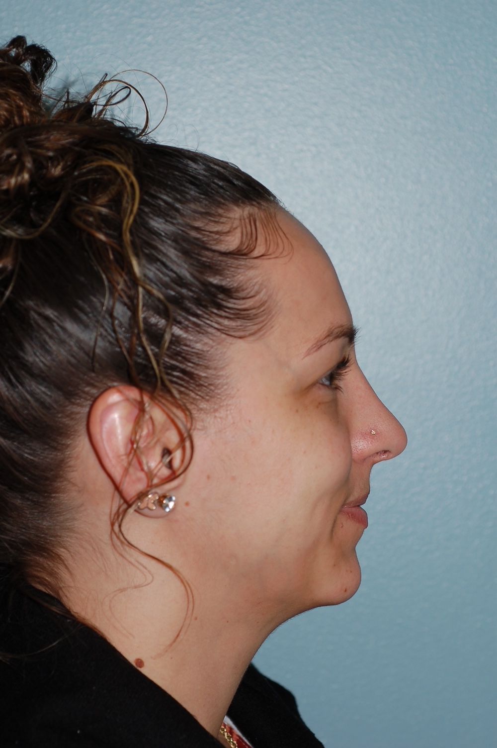 Rhinoplasty Procedure 4 — North Shore Facial Plastic Surgery —  Danvers, MA