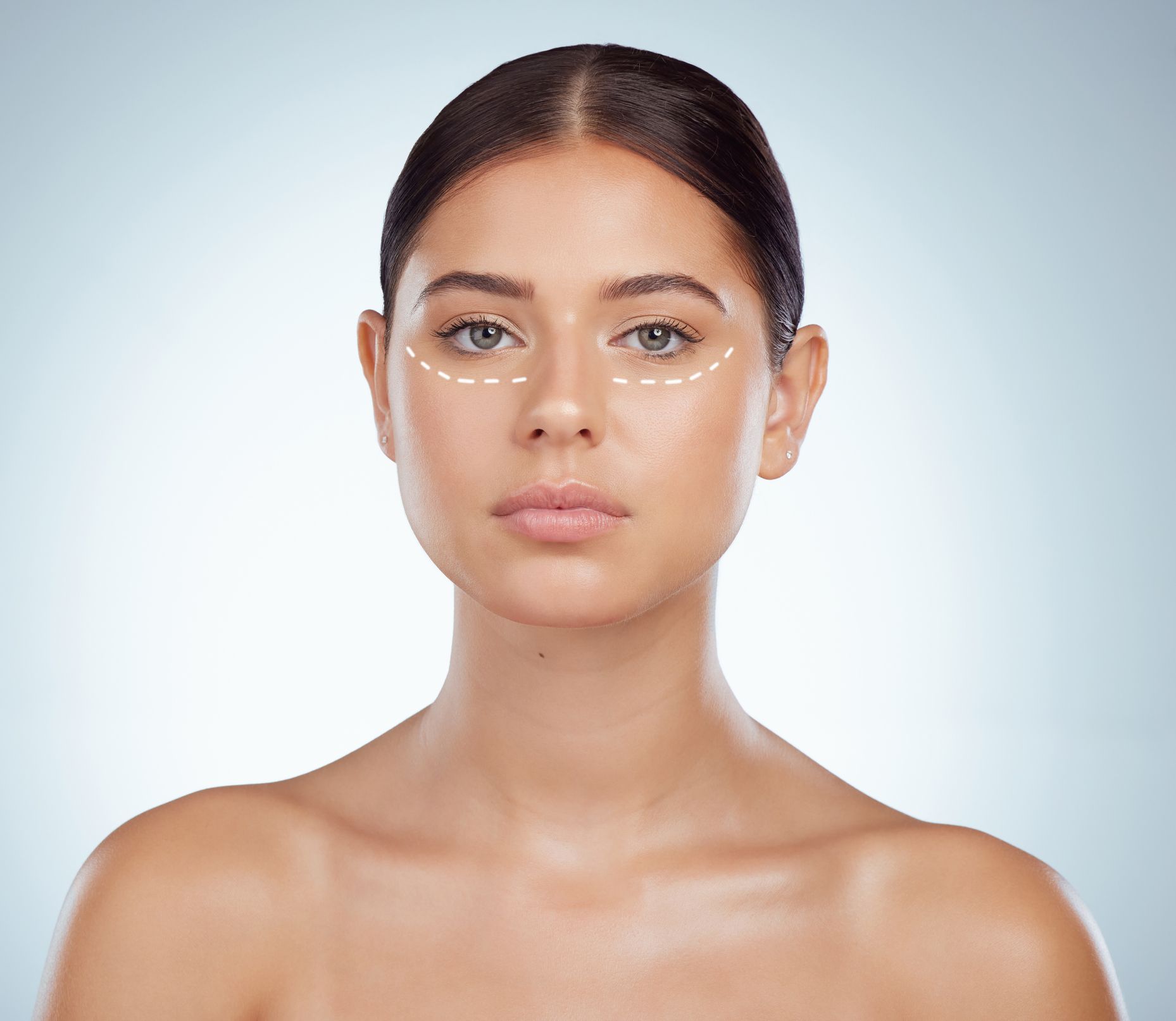 Portrait Of Woman With Dotted Line Marking Undereye For Eyelift Surgery – Danvers, MA – North Shore Facial Plastic Surgery