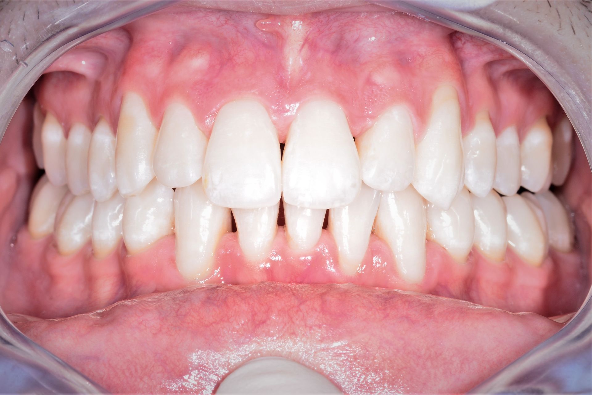 Orthodontie adulte cas 2 après