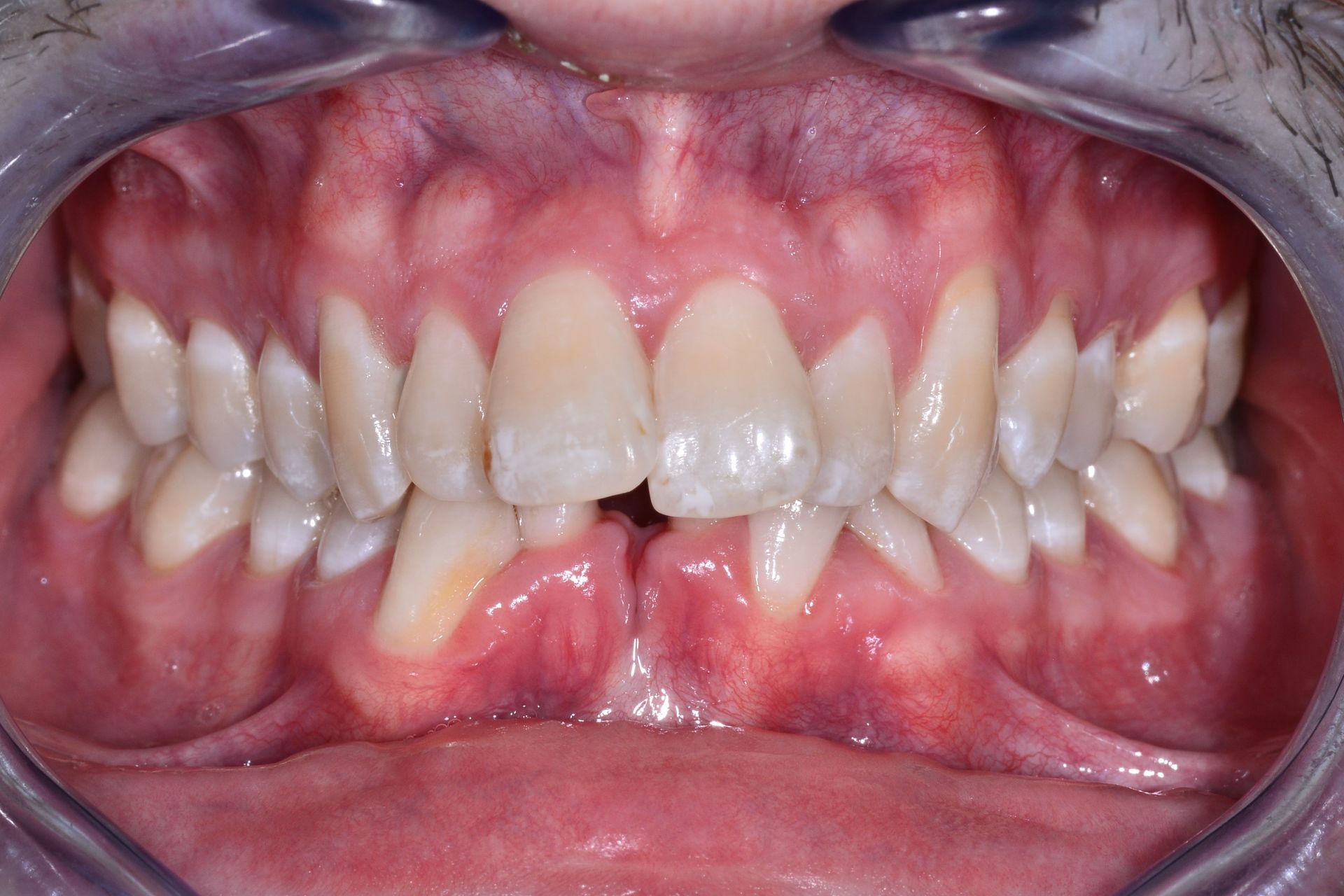 Orthodontie adulte cas 2 avant