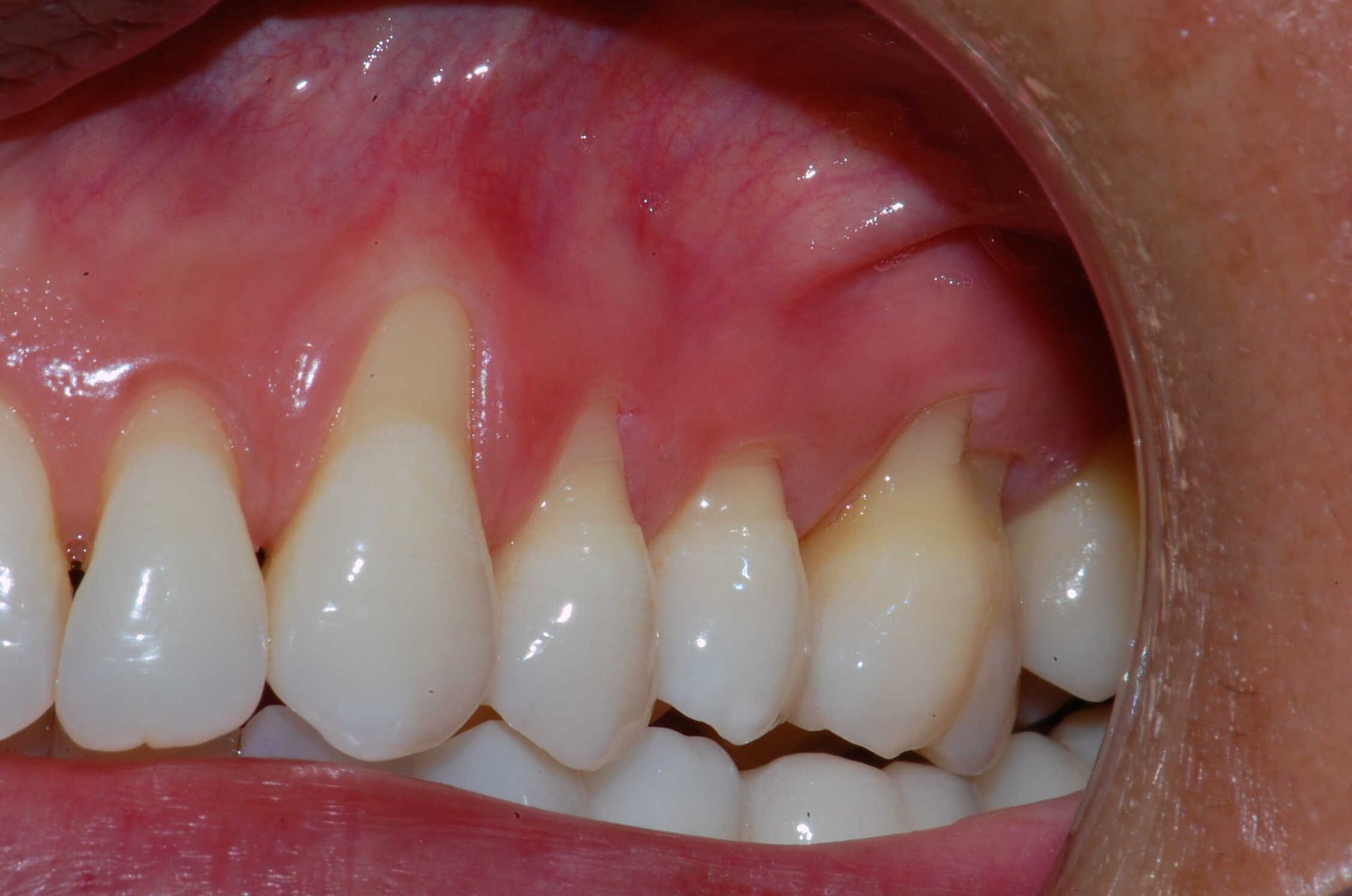 Soins parodontaux cas 2 avant