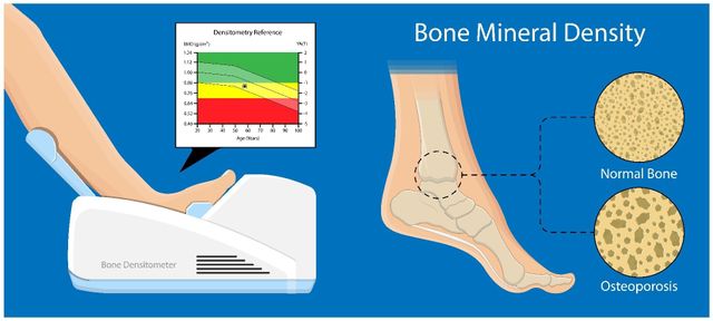 Bone mineral. Bone Mineral density. Densest Mineral. Bone Mineral density how Compute.