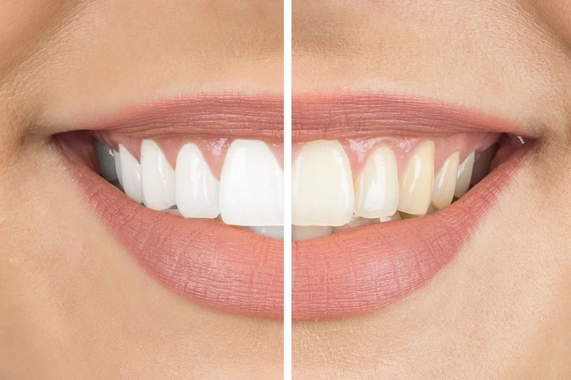 A close up of a woman 's teeth before and after whitening.