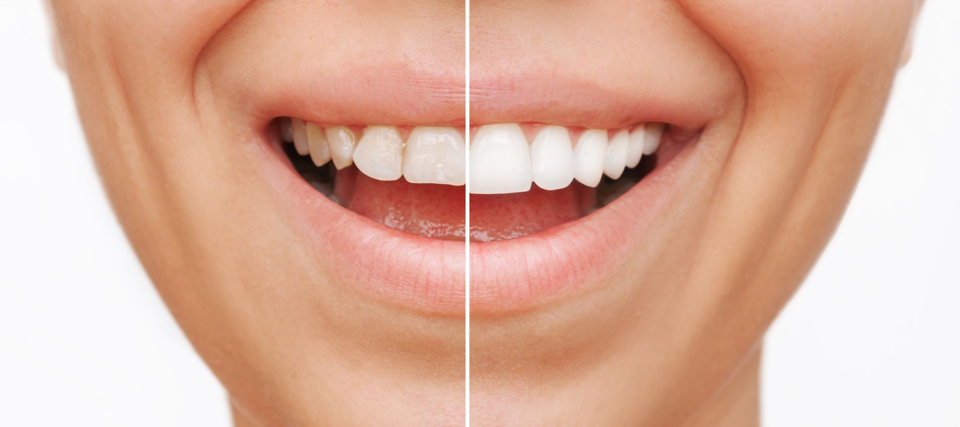 A close up of a woman 's teeth before and after whitening.