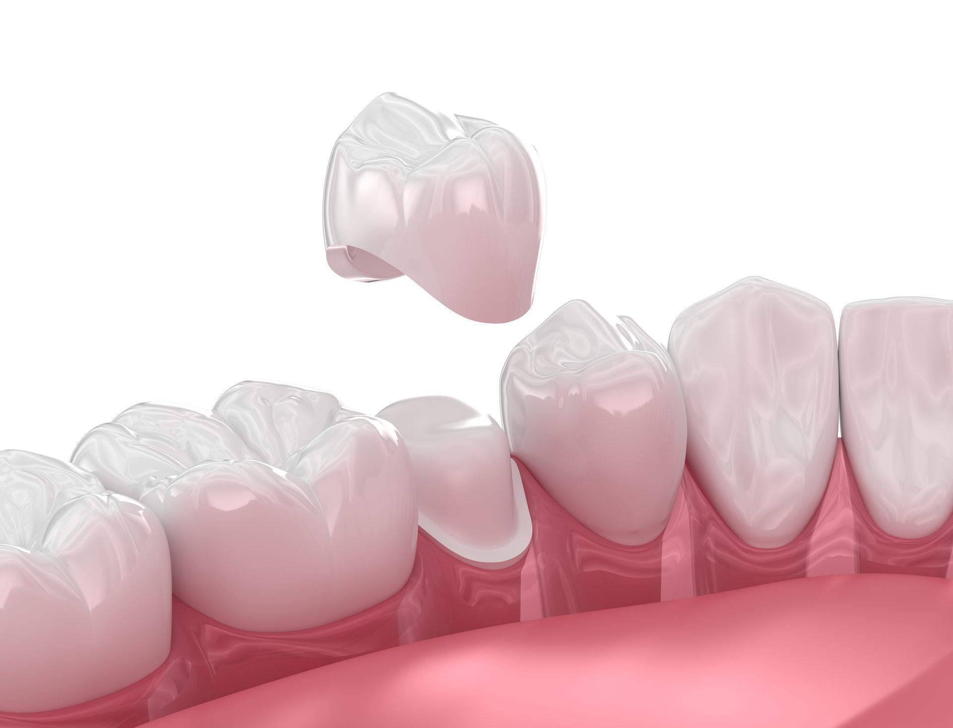 A 3d rendering of a dental crown being placed on a tooth.